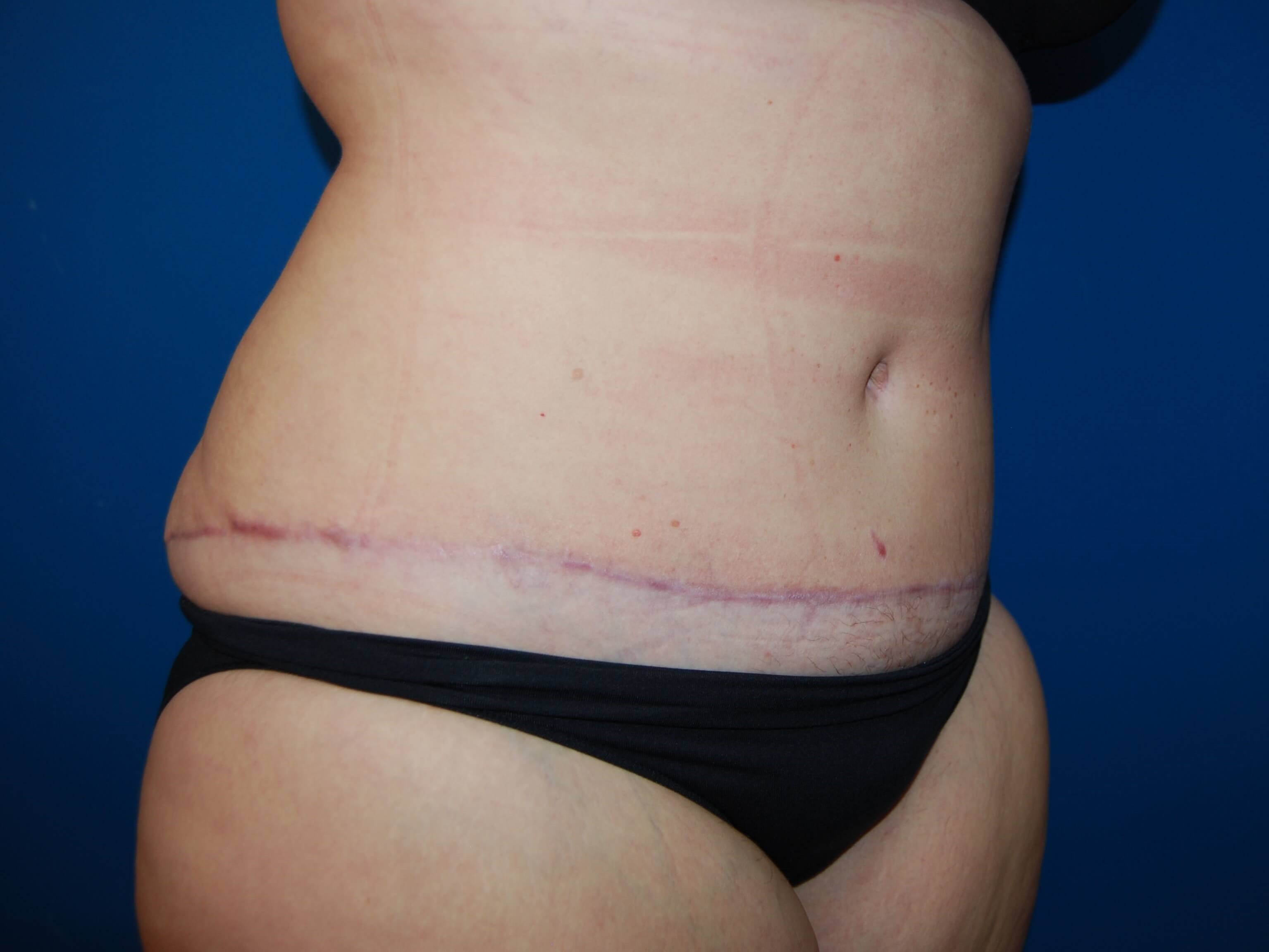 Extended Abdominoplasty Tampa After