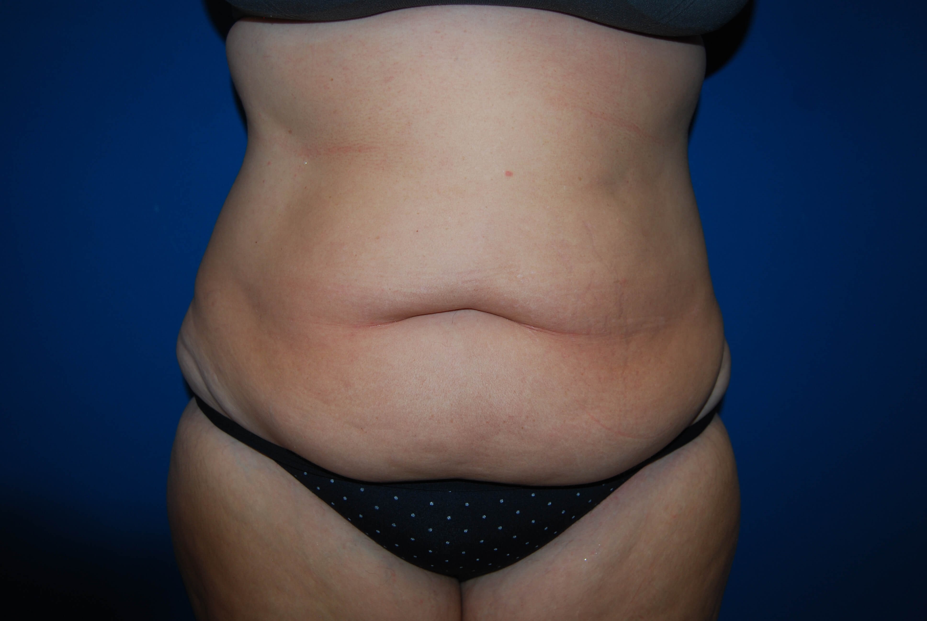 Tummy Tuck St. Pete Before