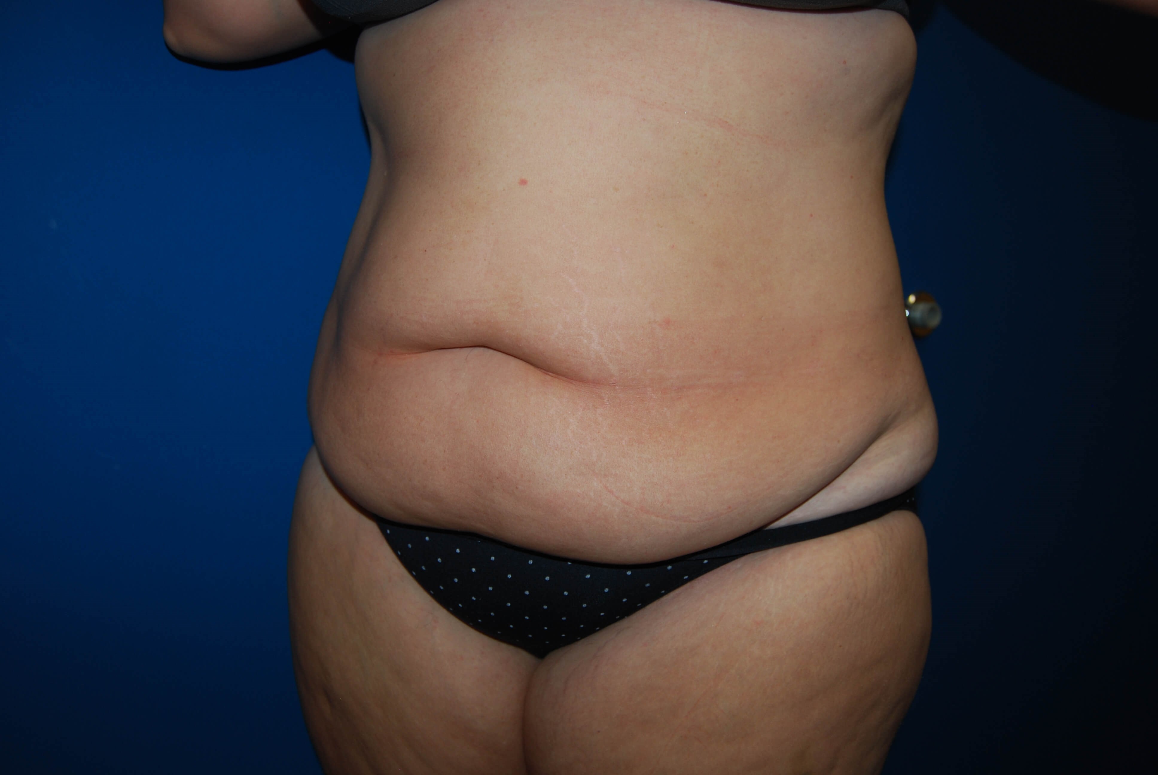 Abdominoplasty St. Petersburg Before