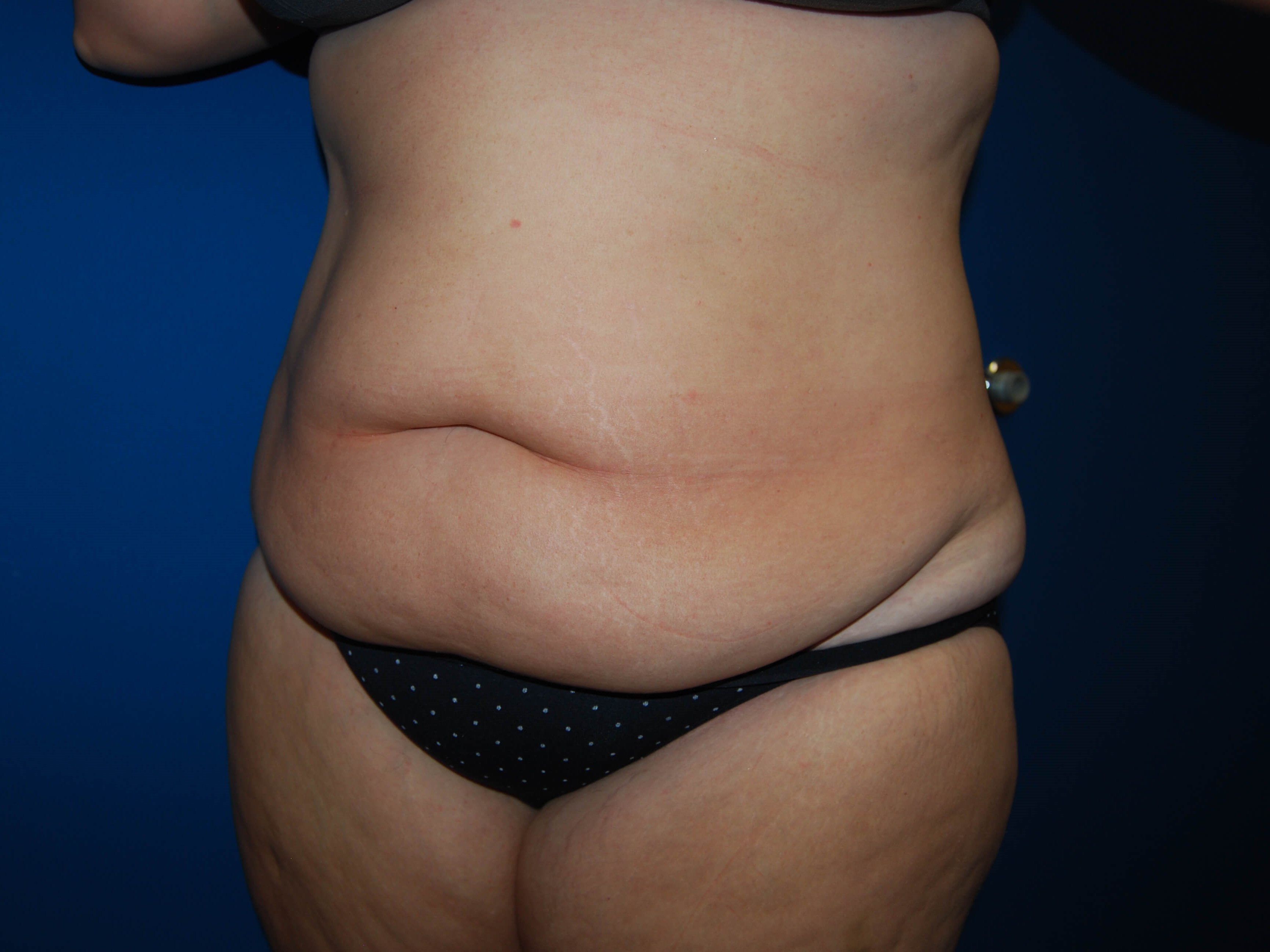 Abdominoplasty St. Petersburg Before