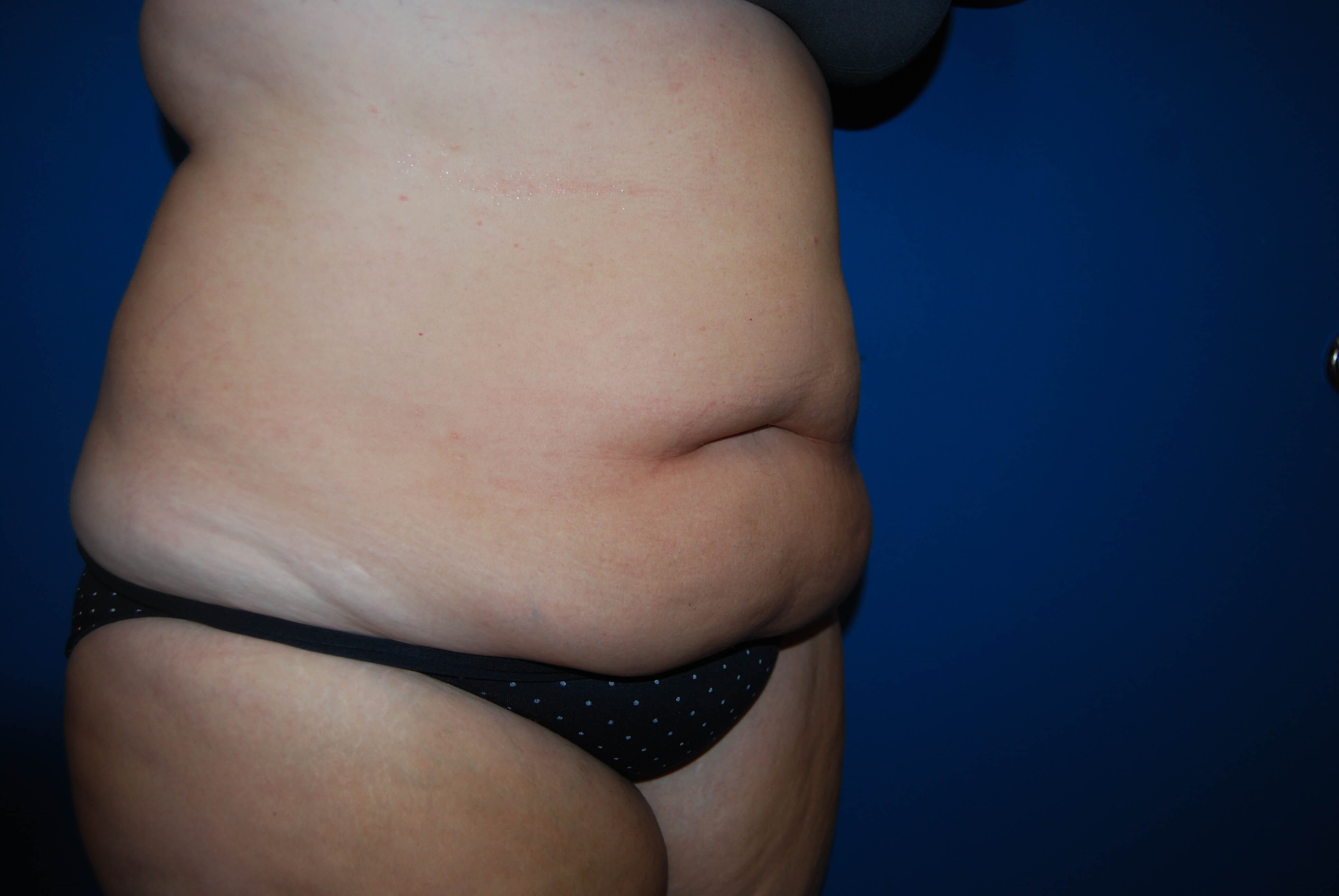 Extended Abdominoplasty Tampa Before