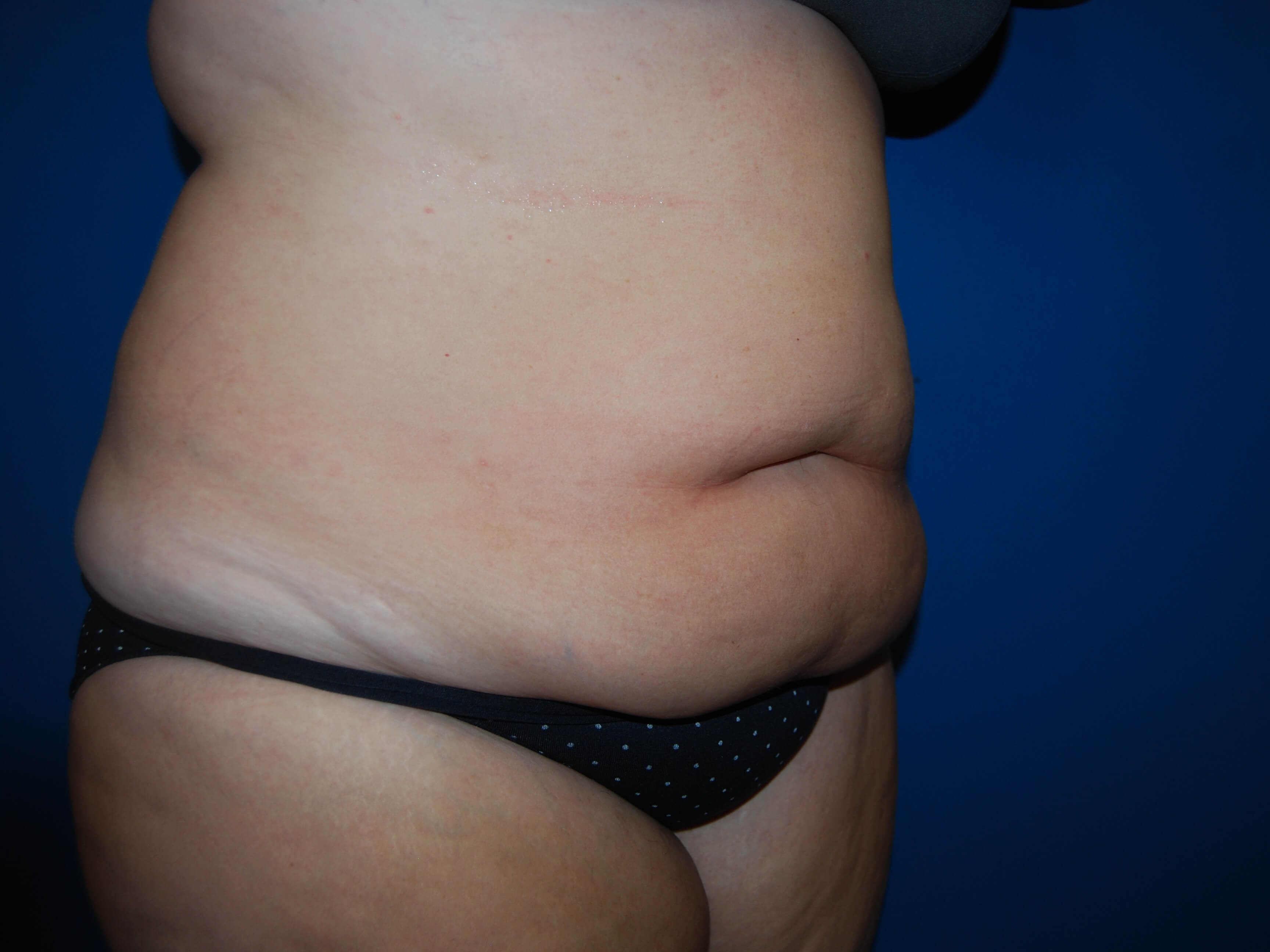 Extended Abdominoplasty Tampa Before
