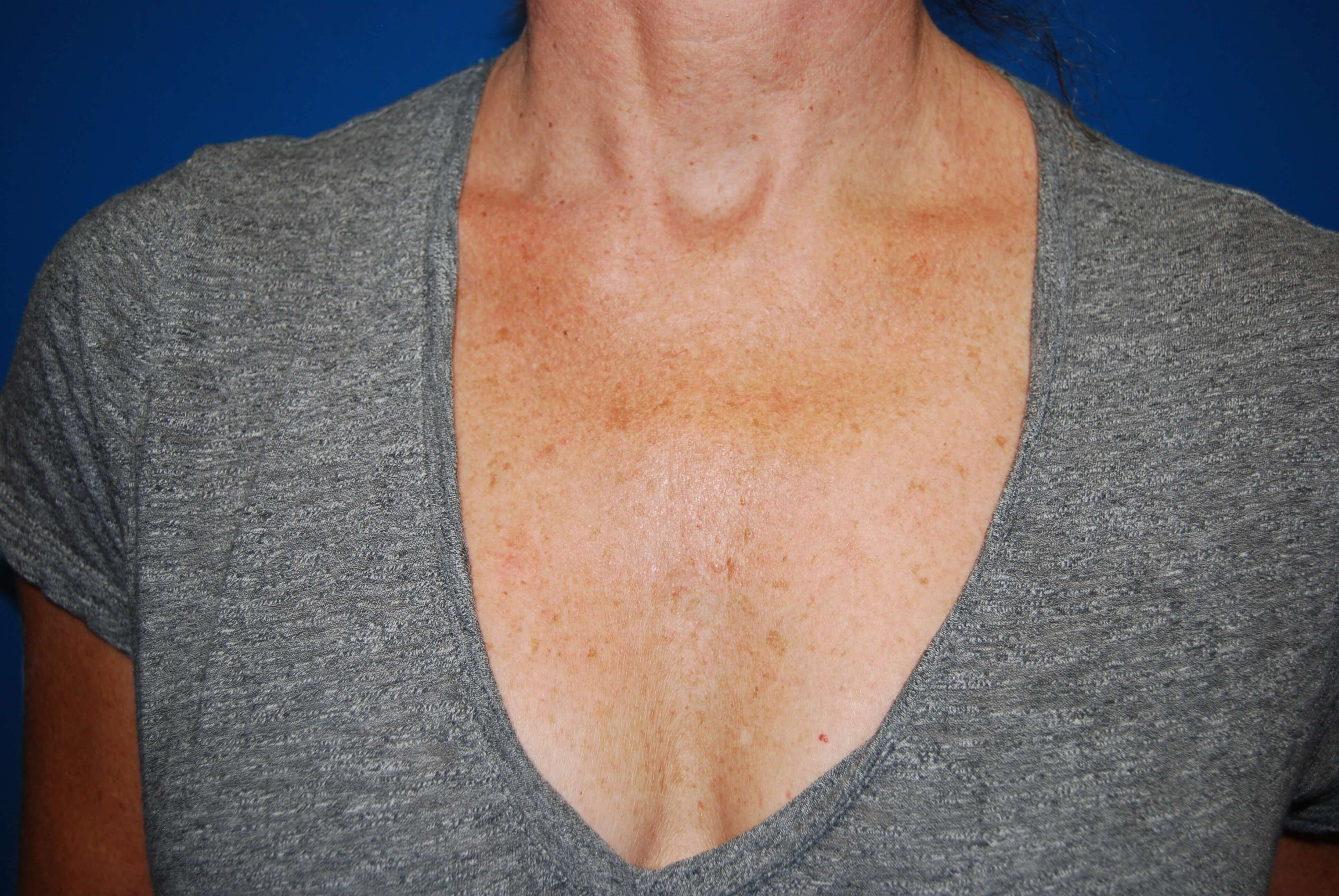 Broad Band Light Treatment Before