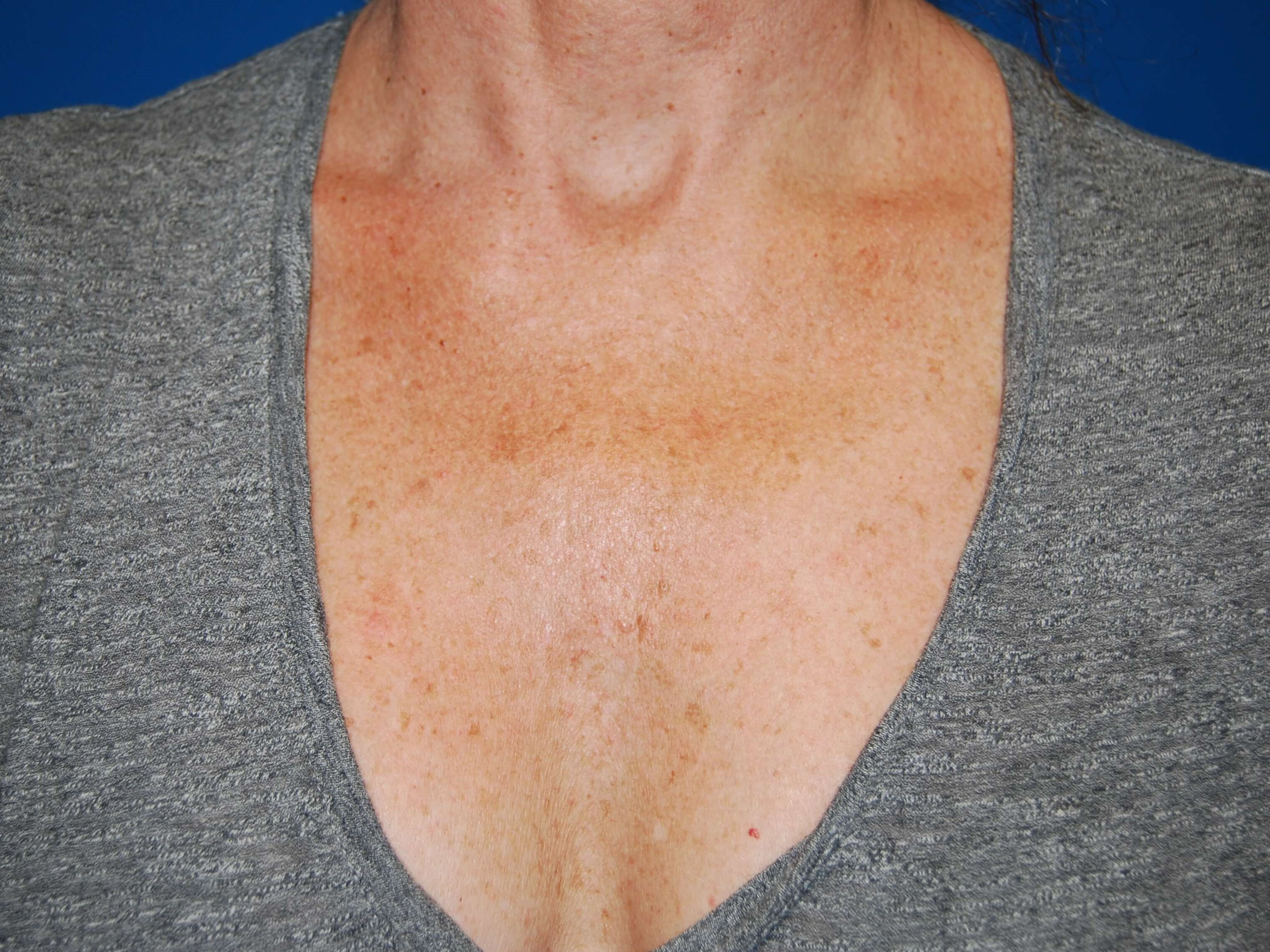 Broad Band Light Treatment Before