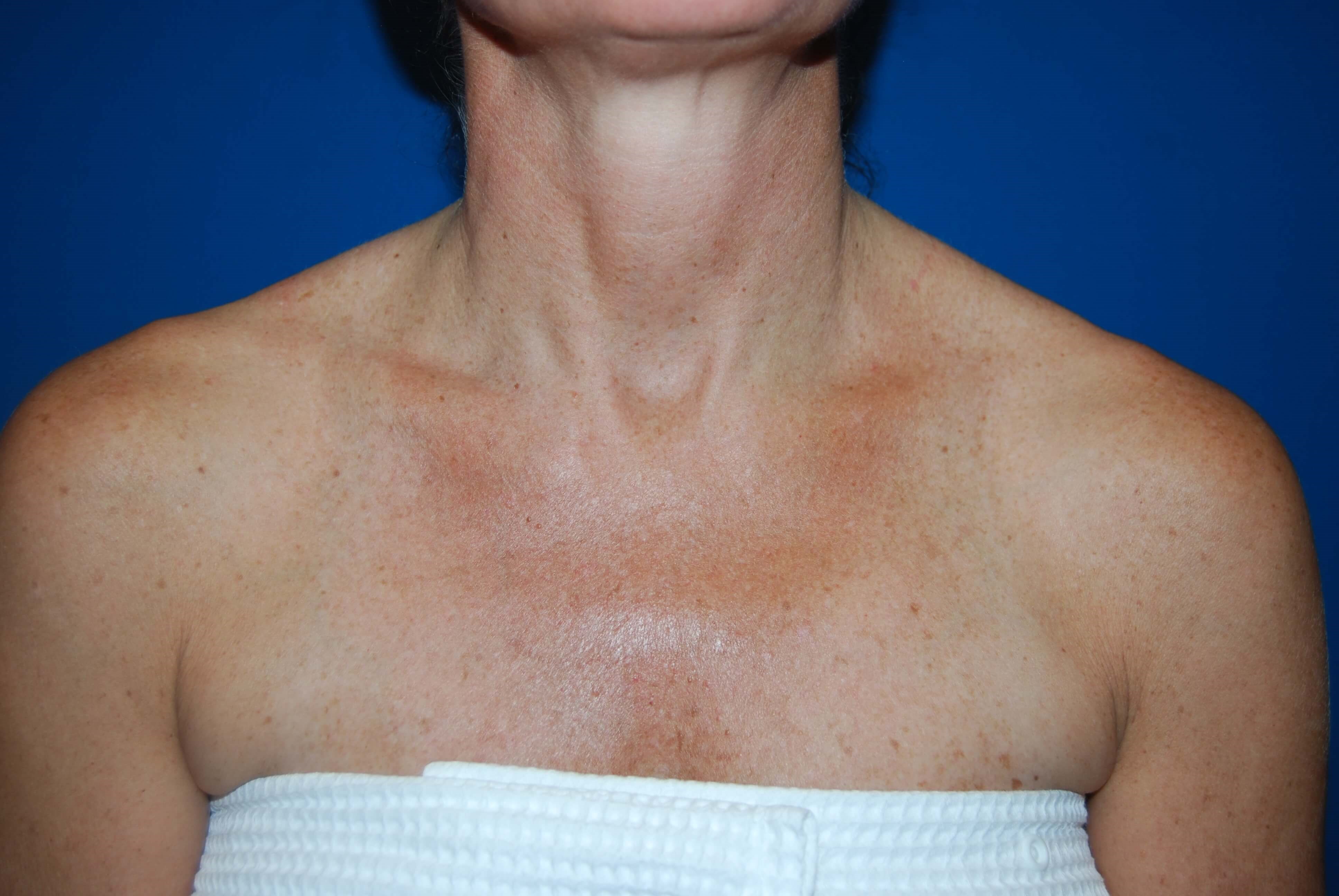 Broad Band Light Treatment After