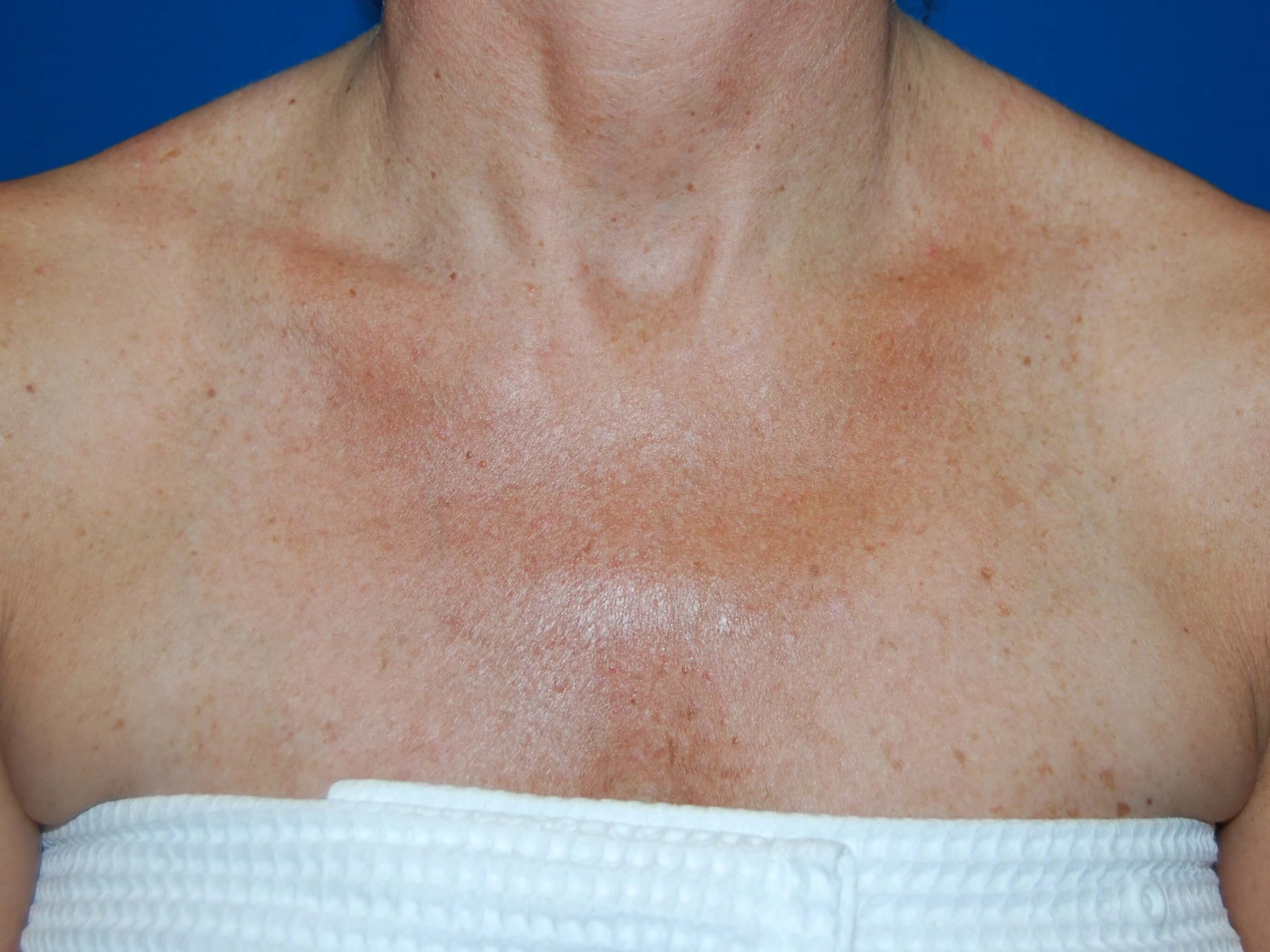 Broad Band Light Treatment After