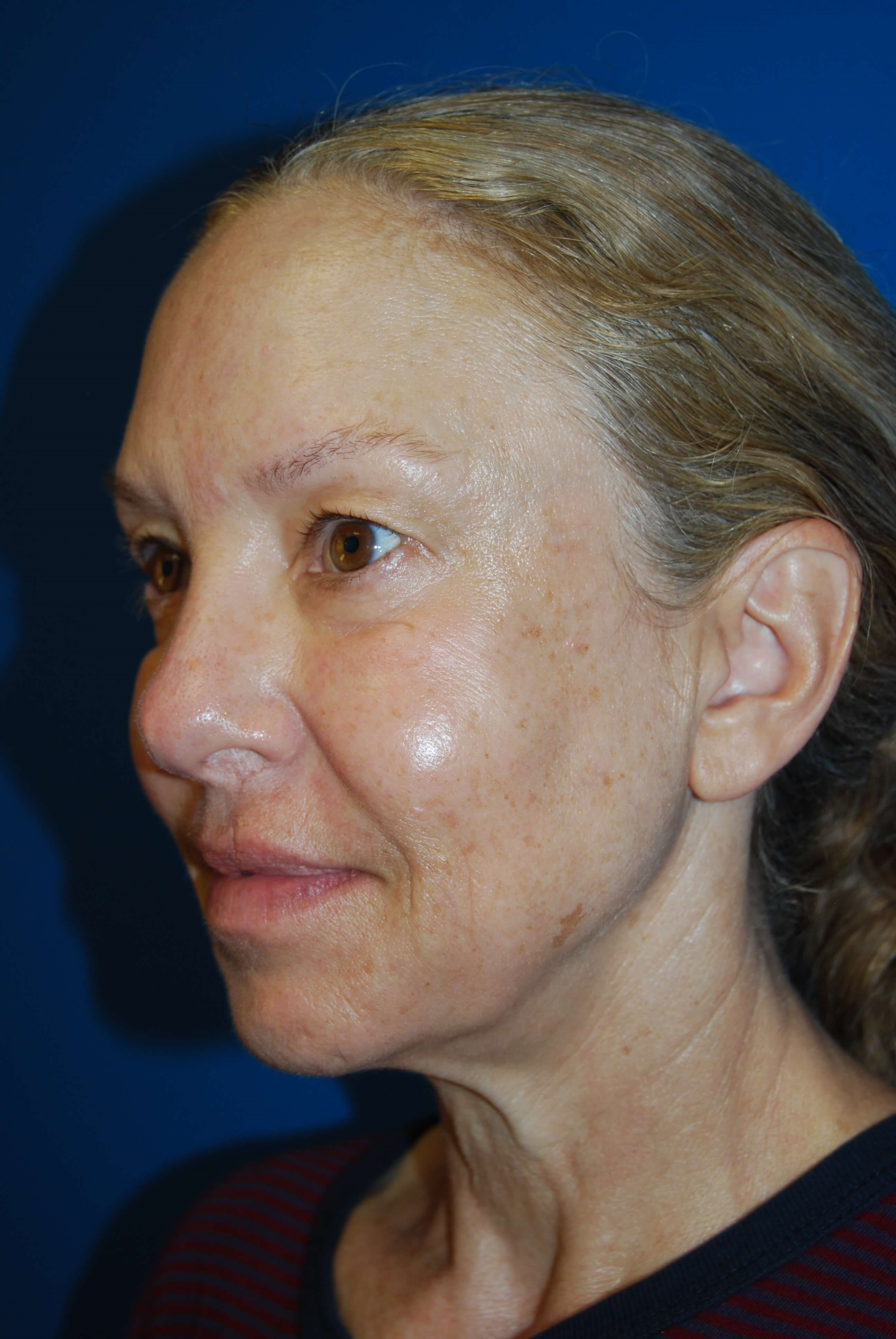 Broad Band Light Treatment Before