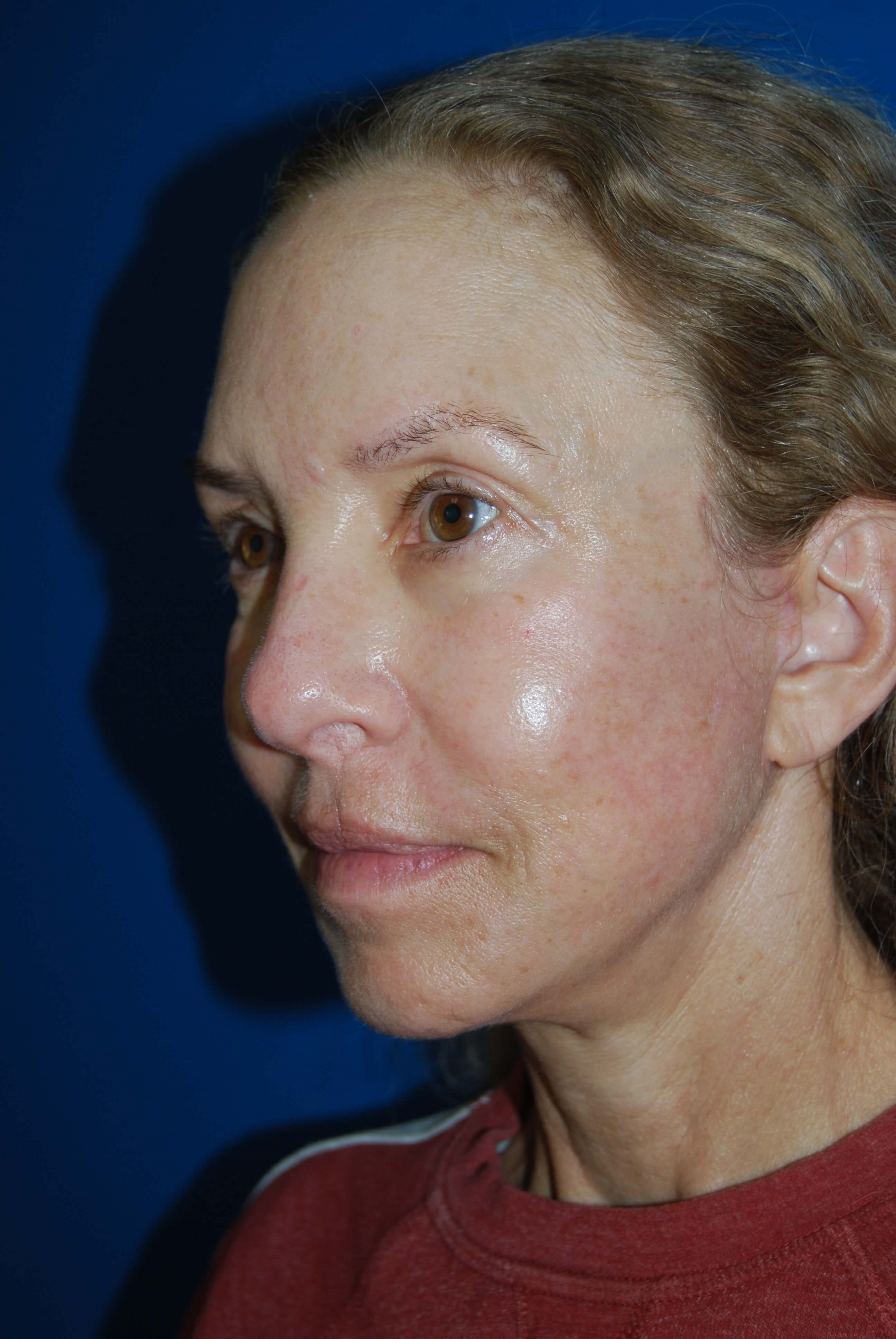 Broad Band Light Treatment After