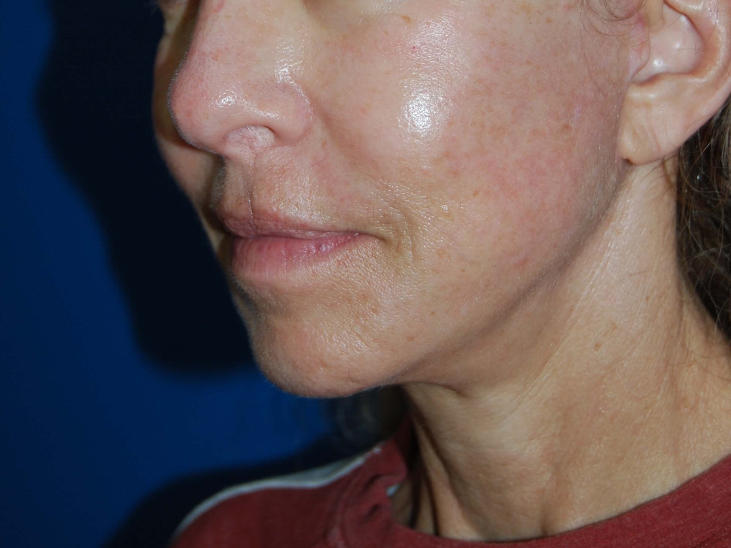 Broad Band Light Treatment After