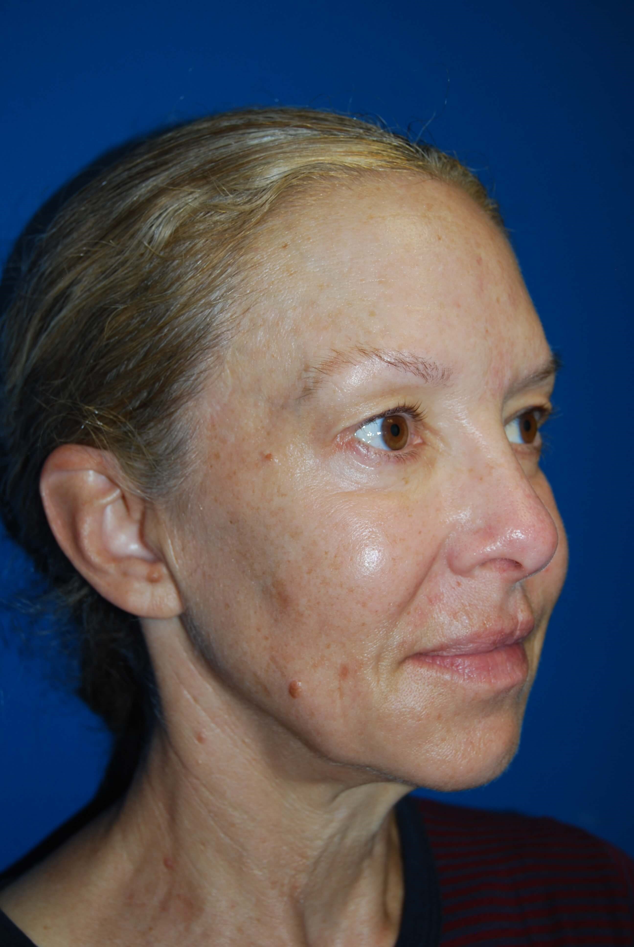 Broad Band Light Treatment Before