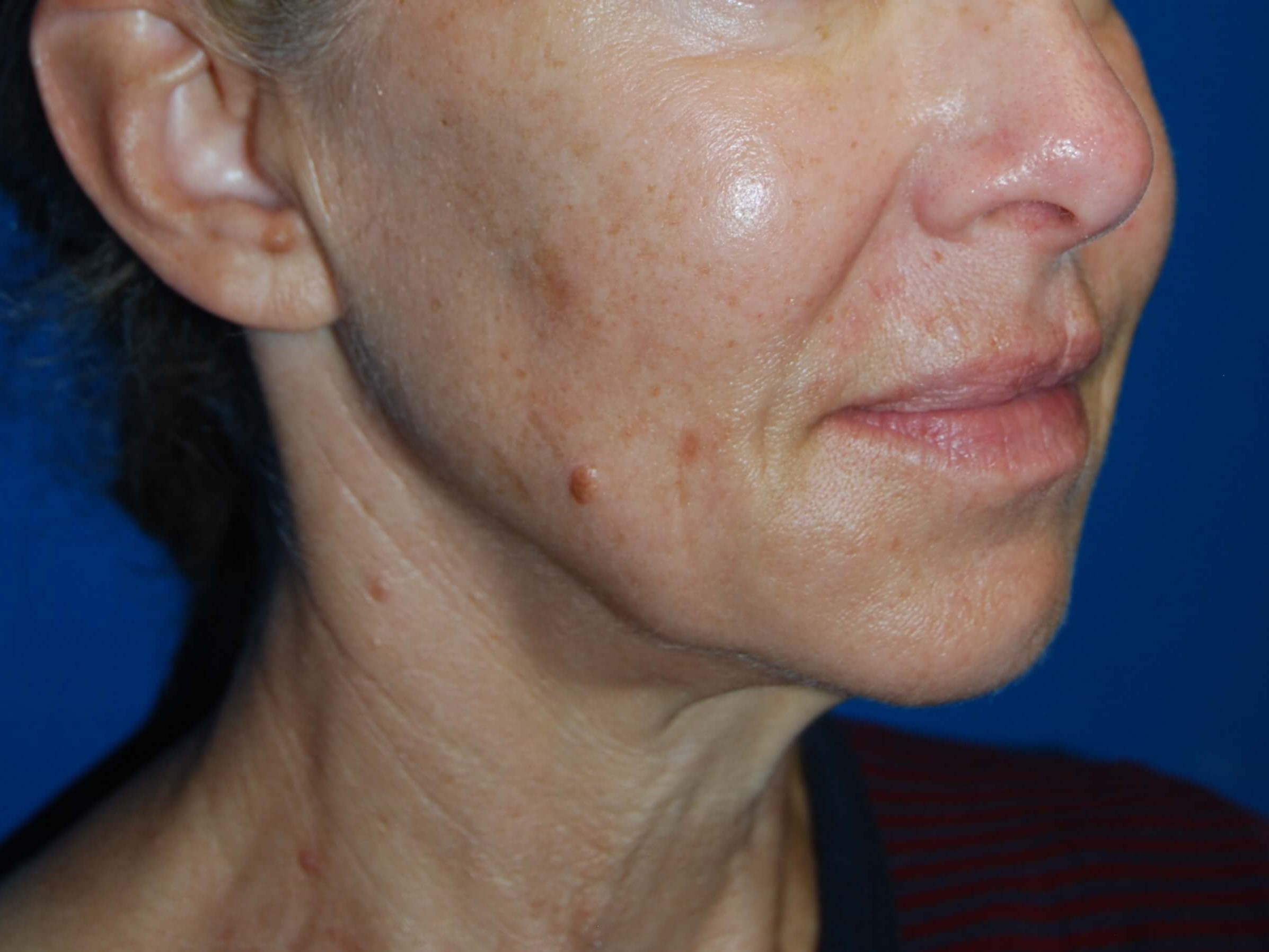 Broad Band Light Treatment Before