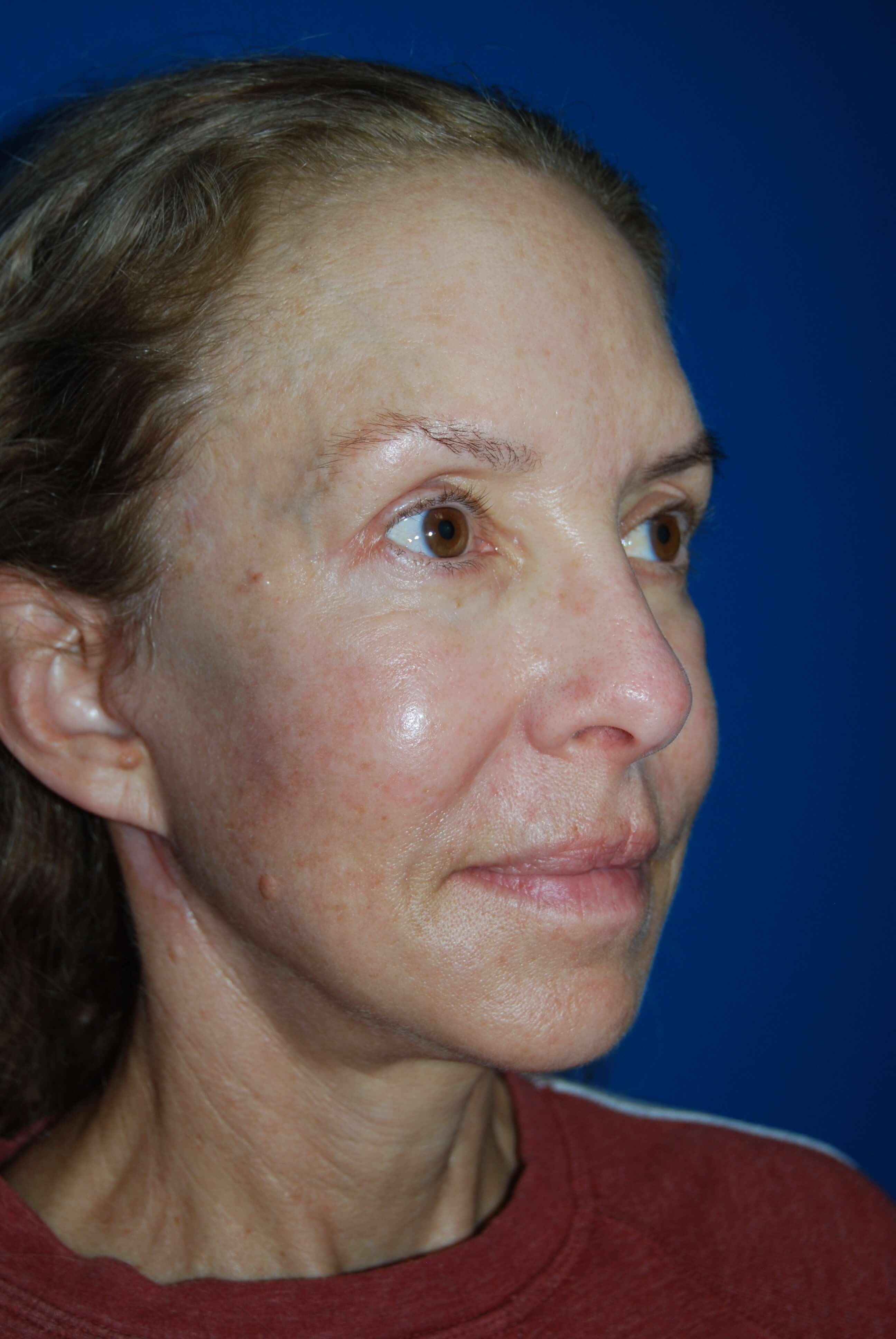 Broad Band Light Treatment After
