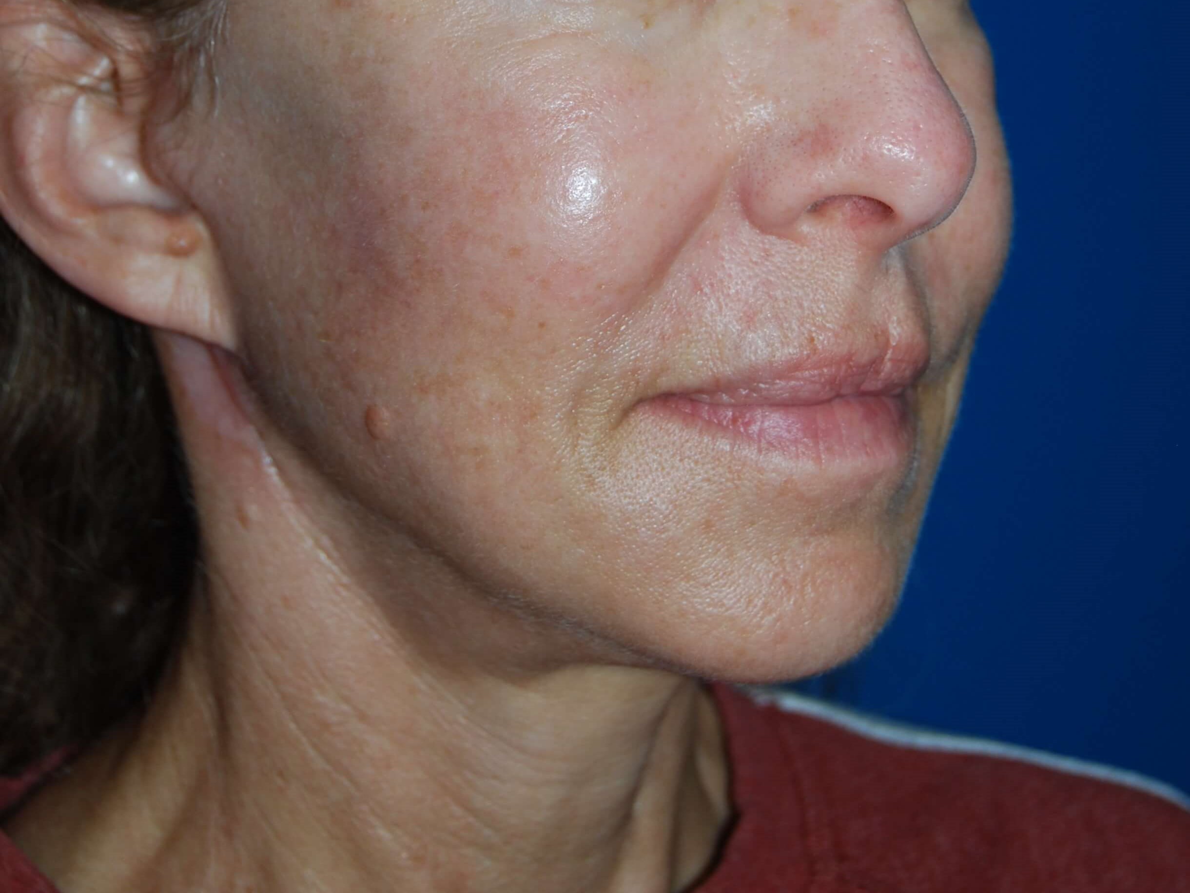 Broad Band Light Treatment After