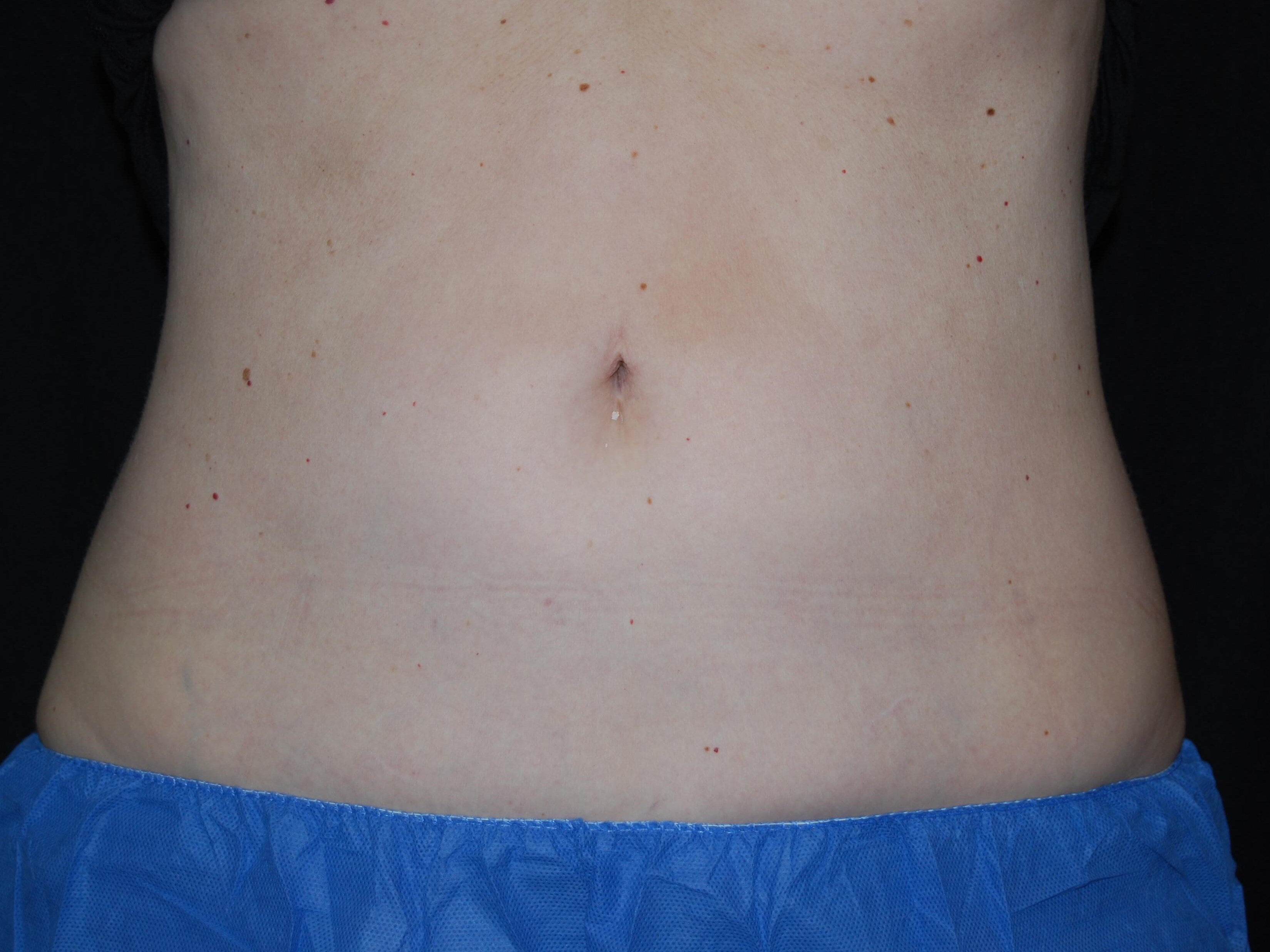 Coolsculpting abdomen After
