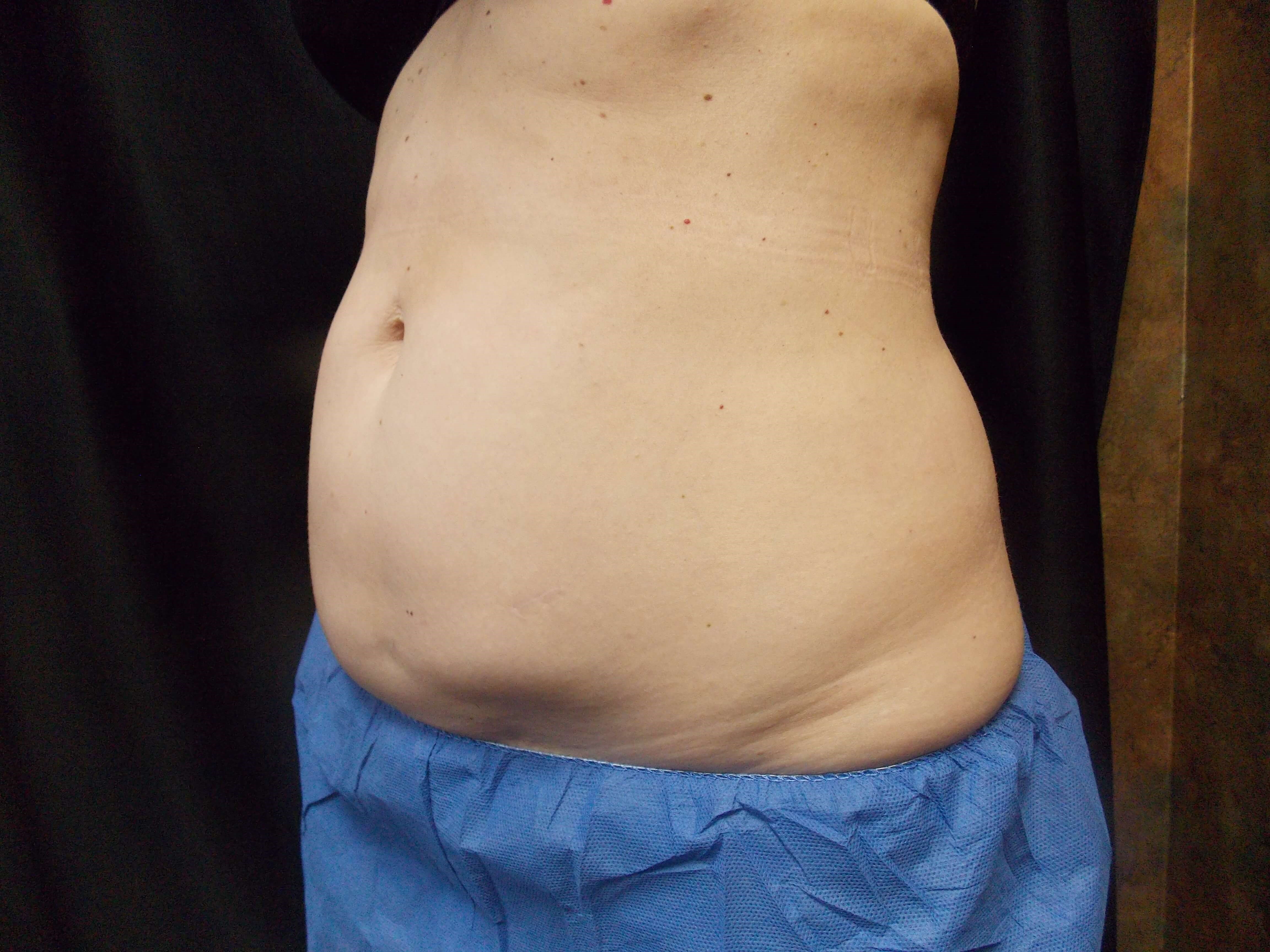 Coolsculpting abdomen Before