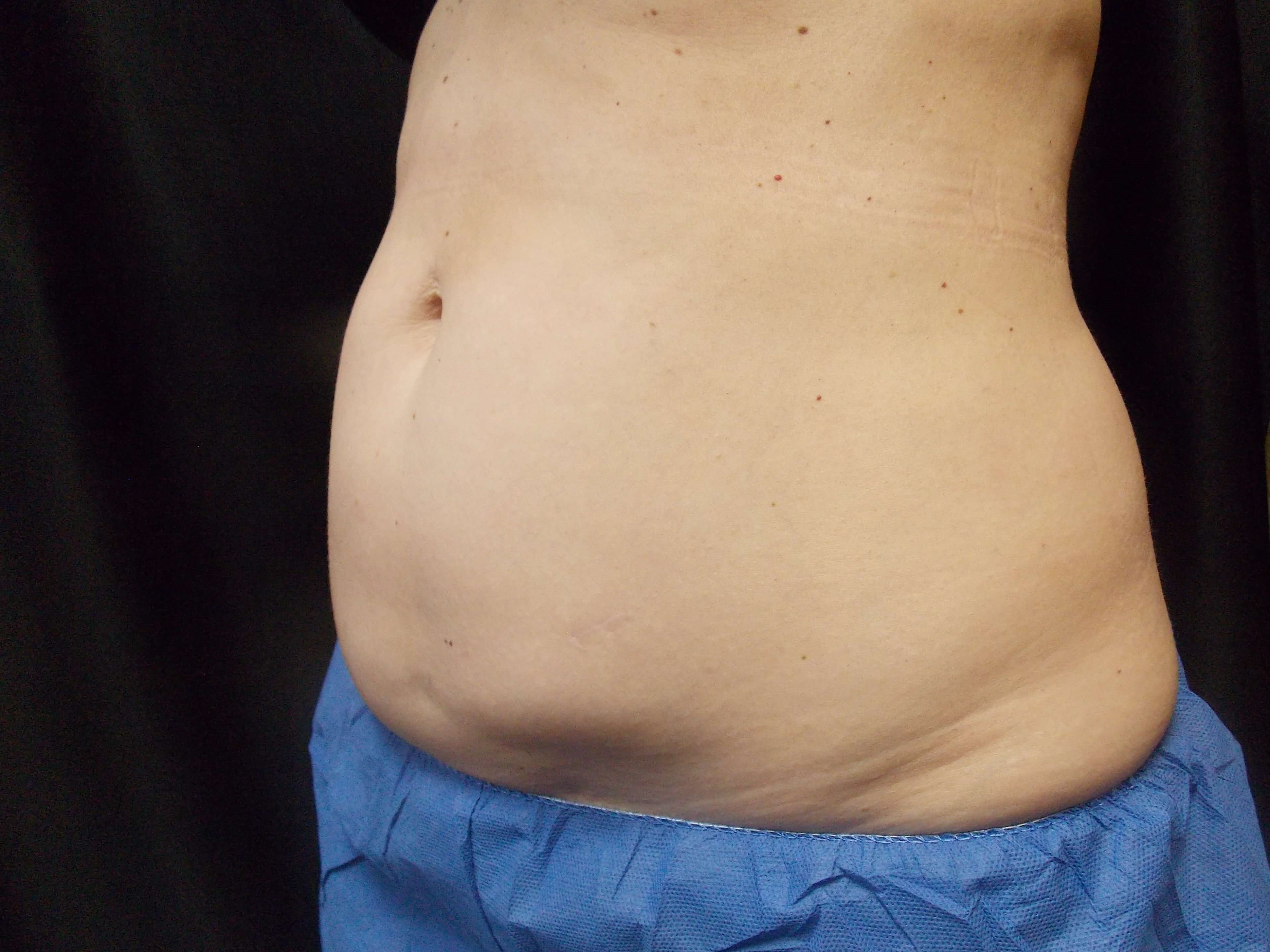 Coolsculpting abdomen Before