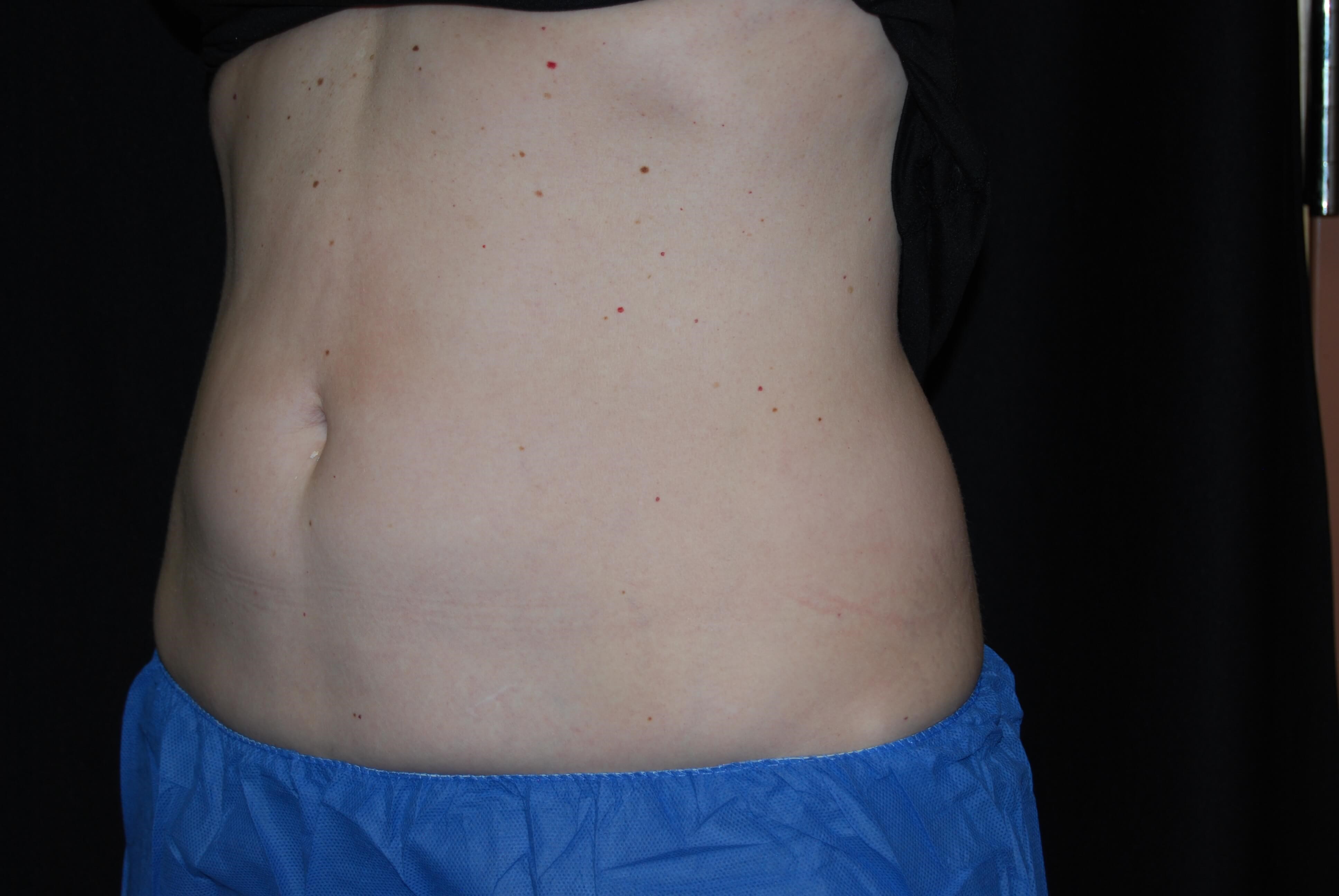 Coolsculpting abdomen After