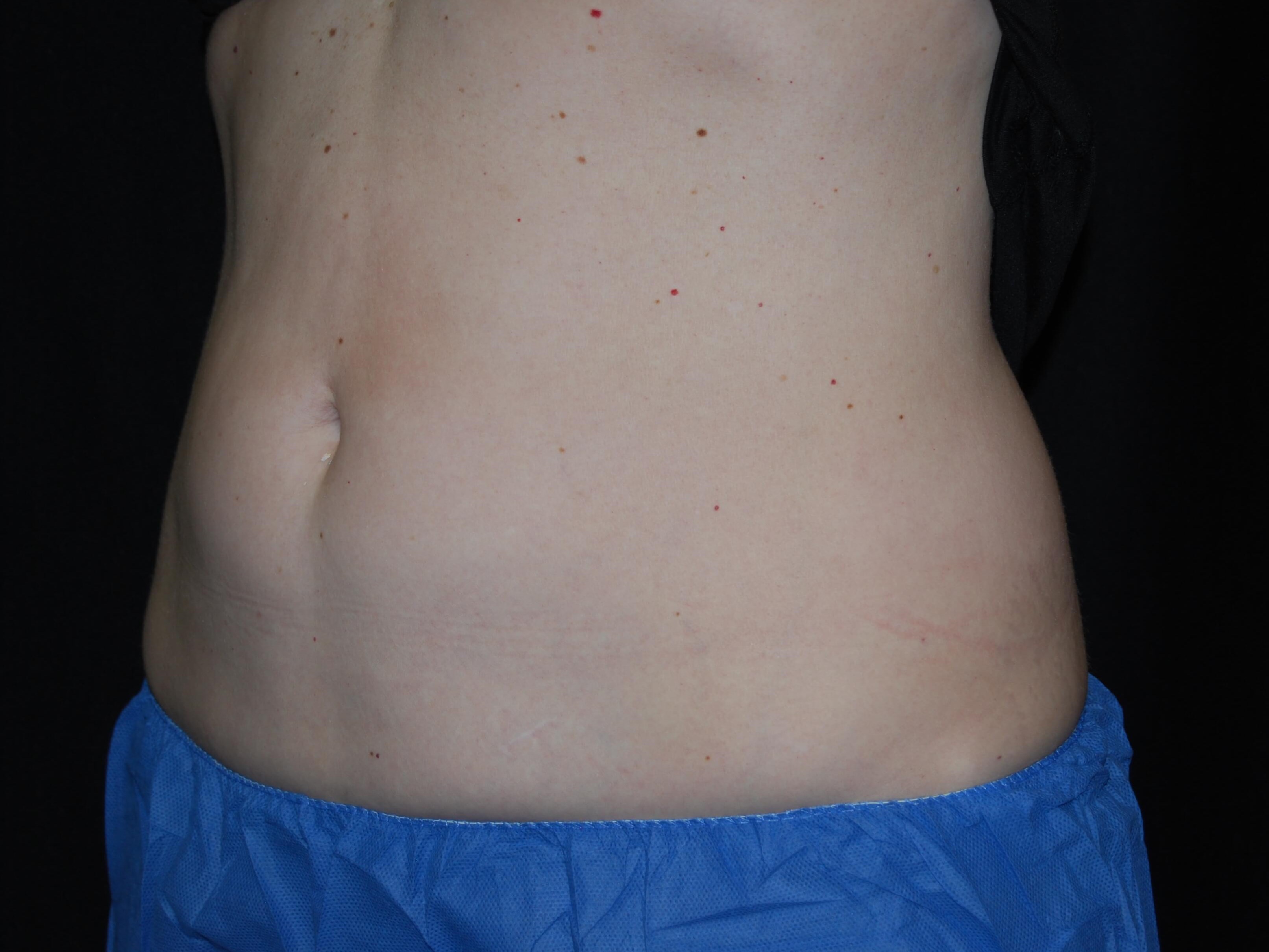Coolsculpting abdomen After
