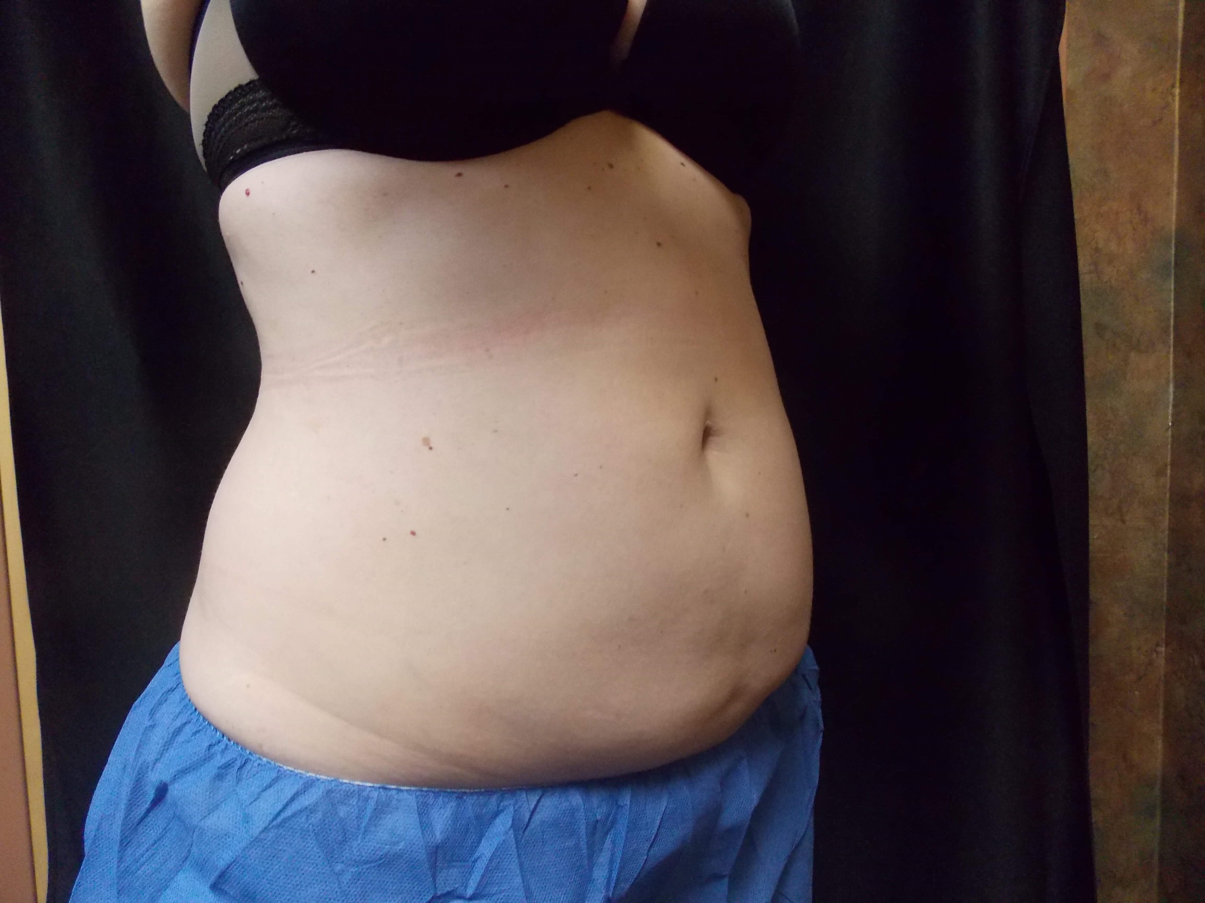 Coolsculpting abdomen Before