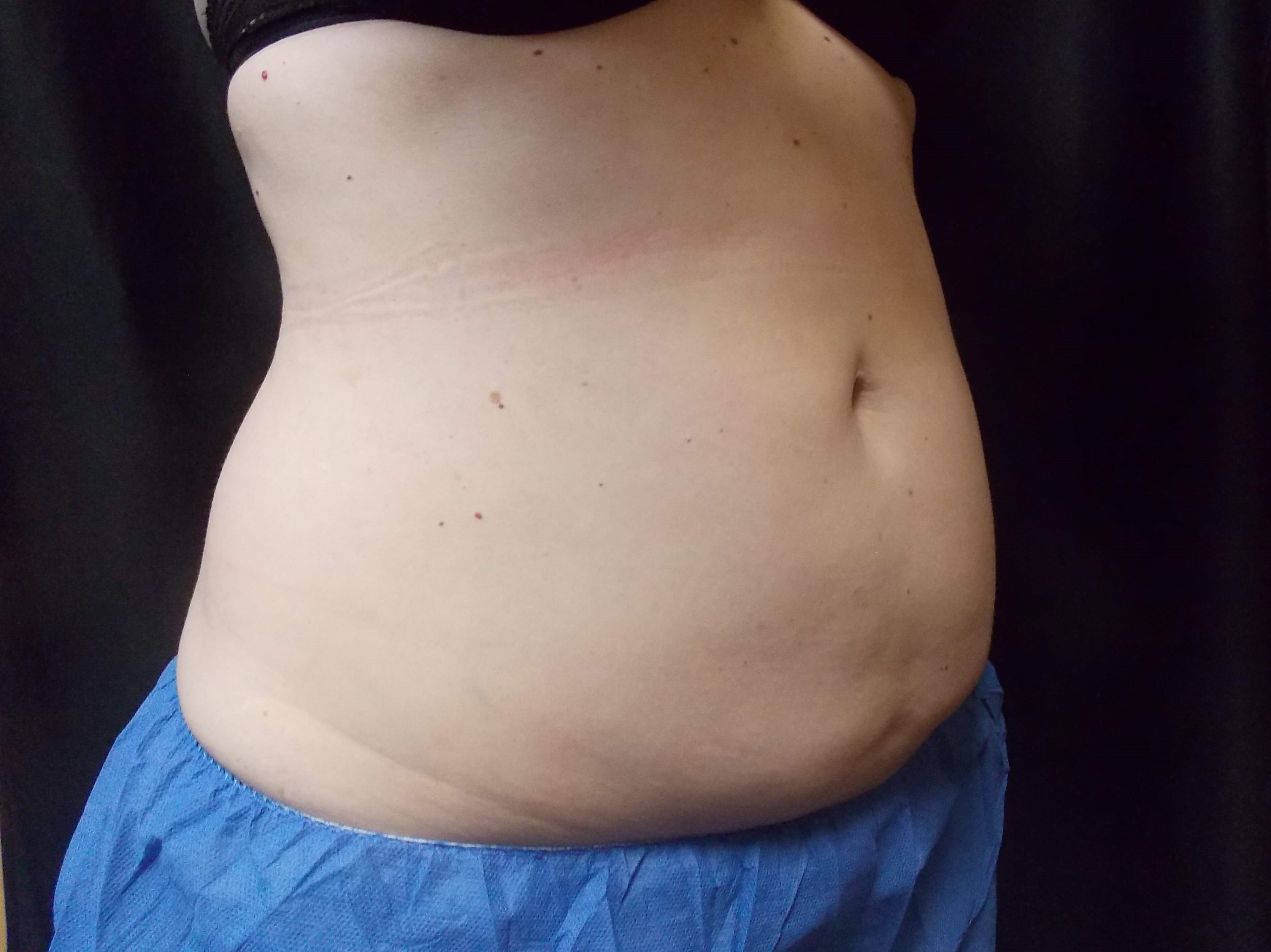 Coolsculpting abdomen Before