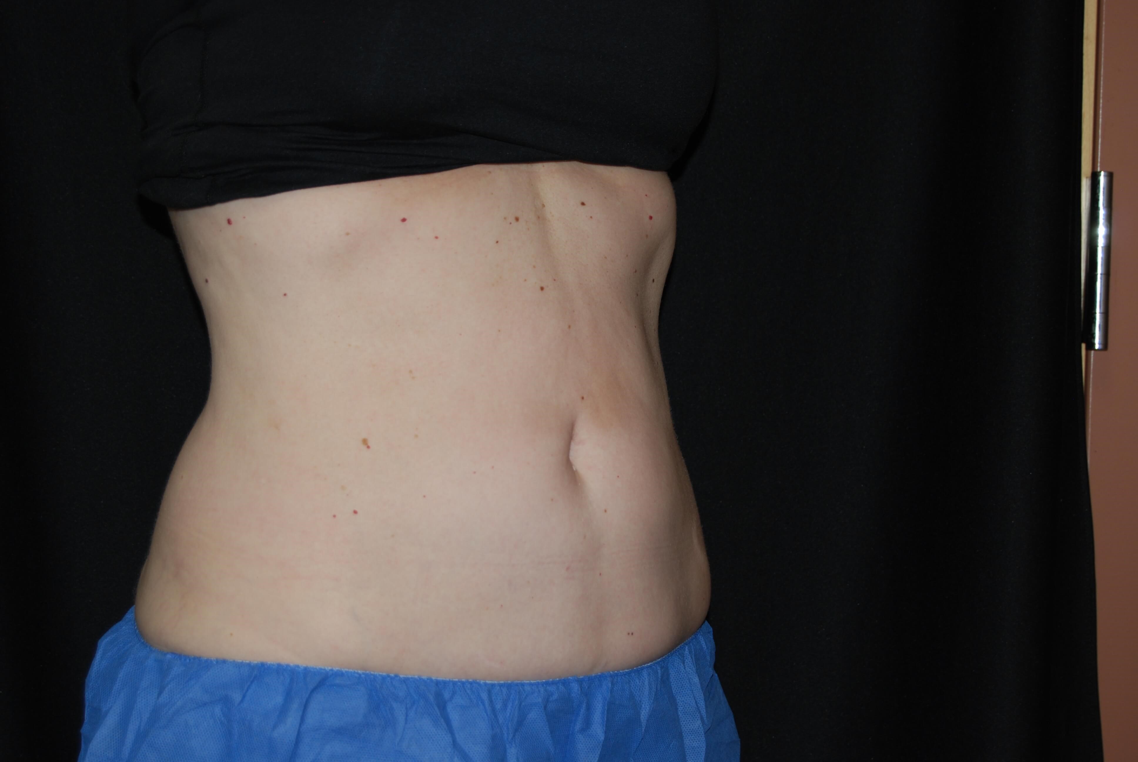 Coolsculpting abdomen After