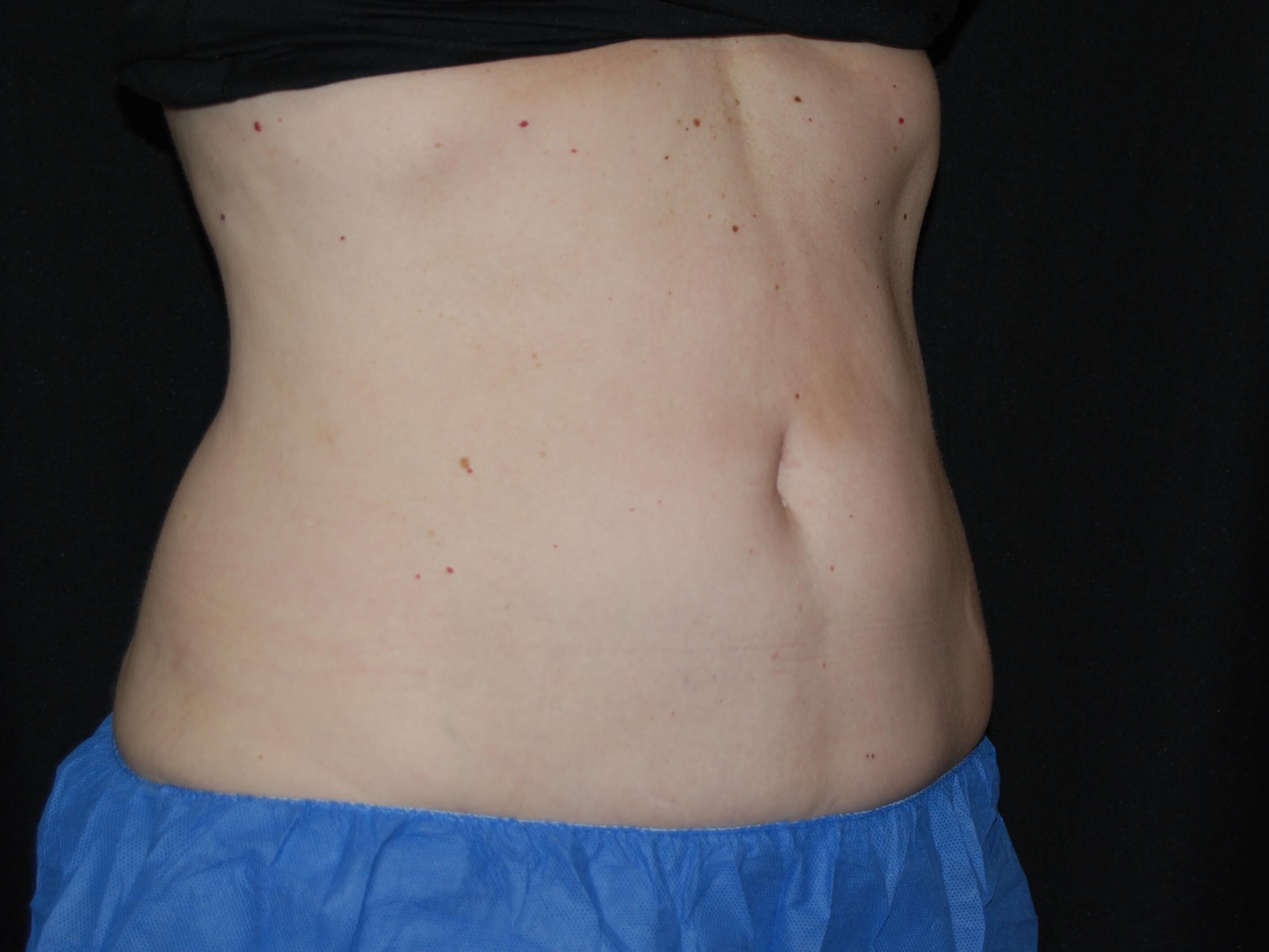 Coolsculpting abdomen After
