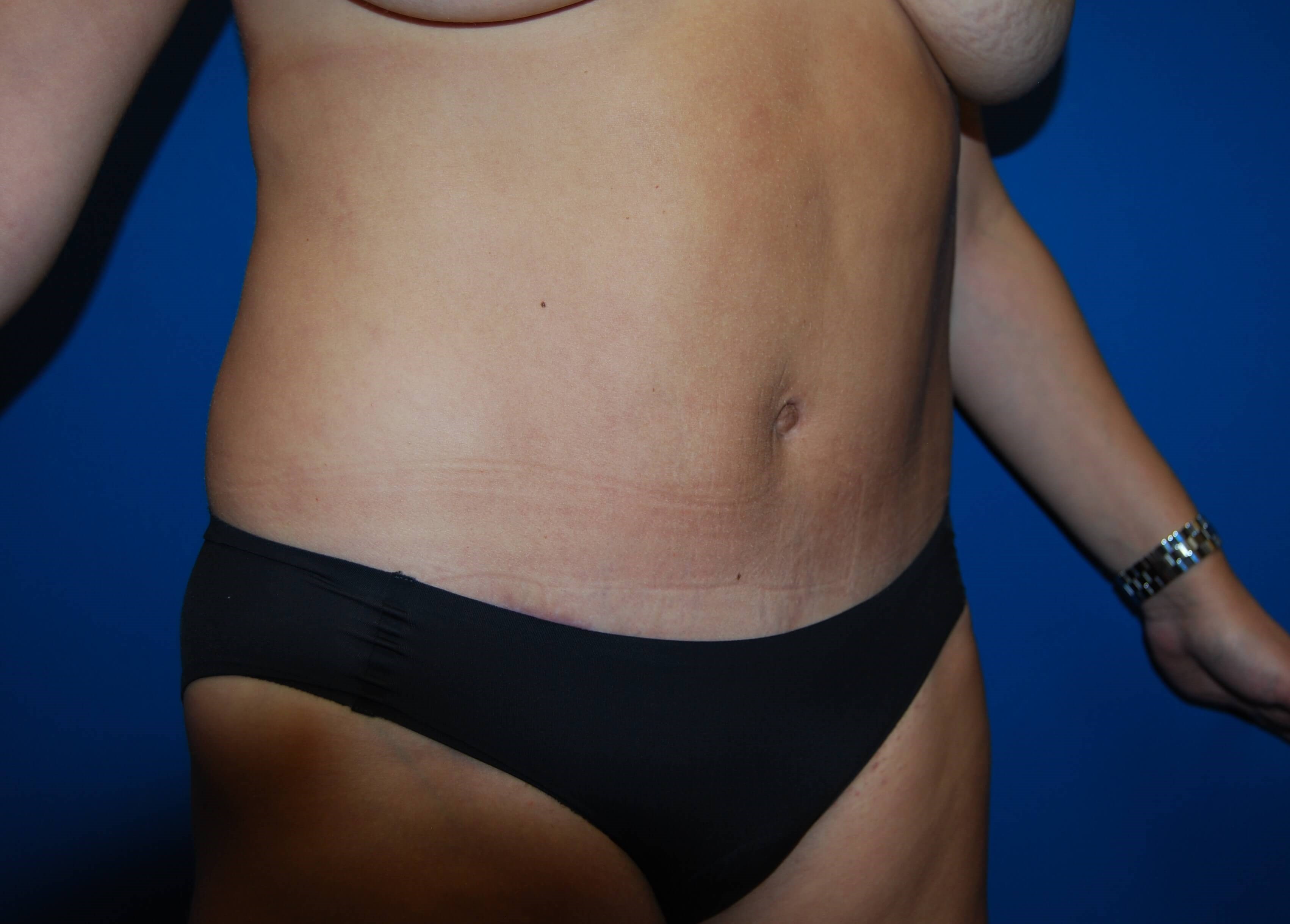 Right After Tummy Tuck