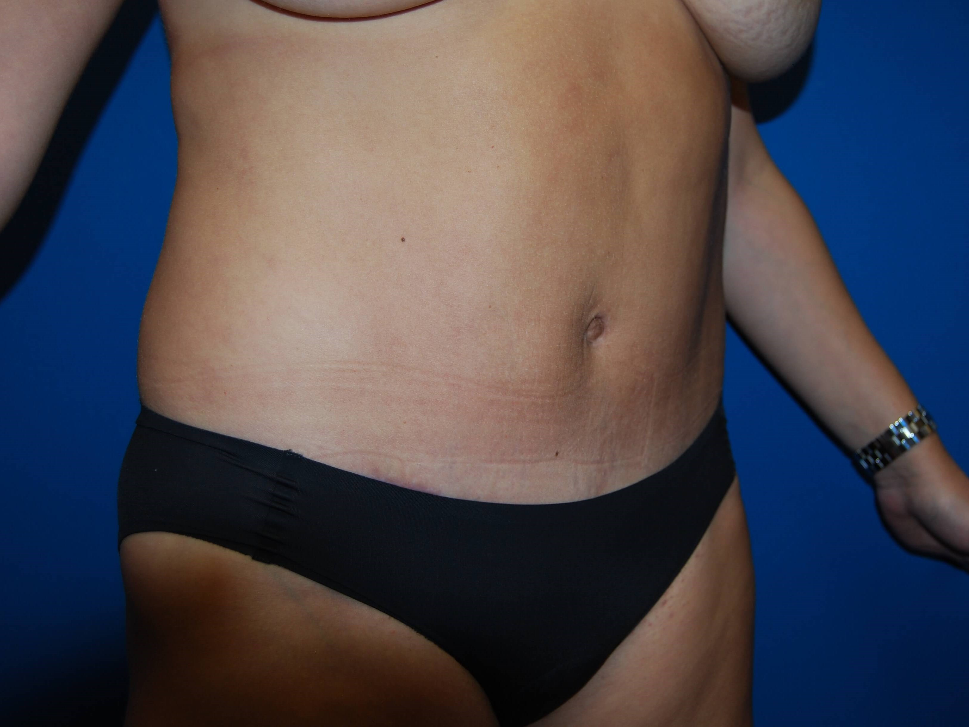 Right After Tummy Tuck