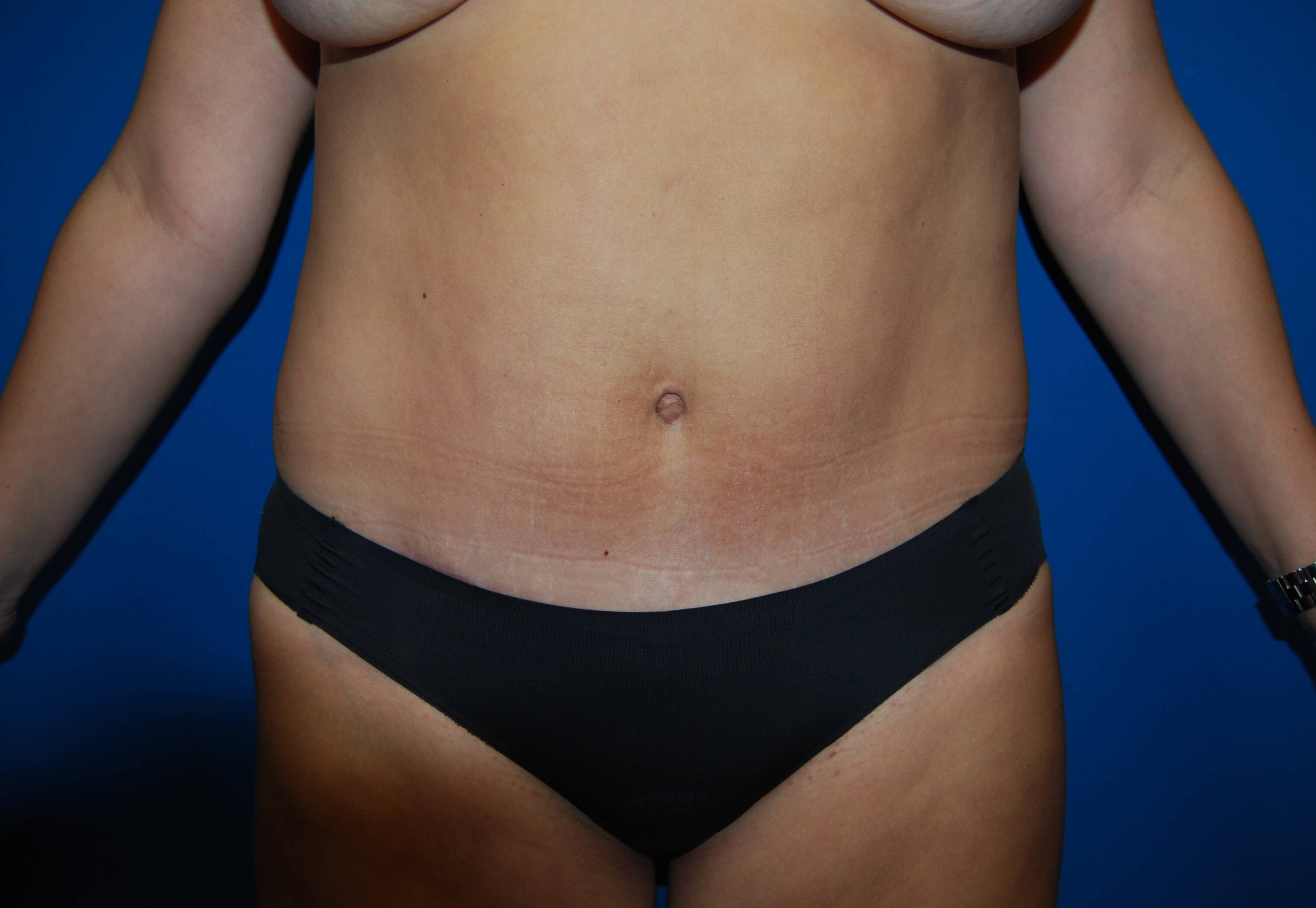 Front After Tummy Tuck