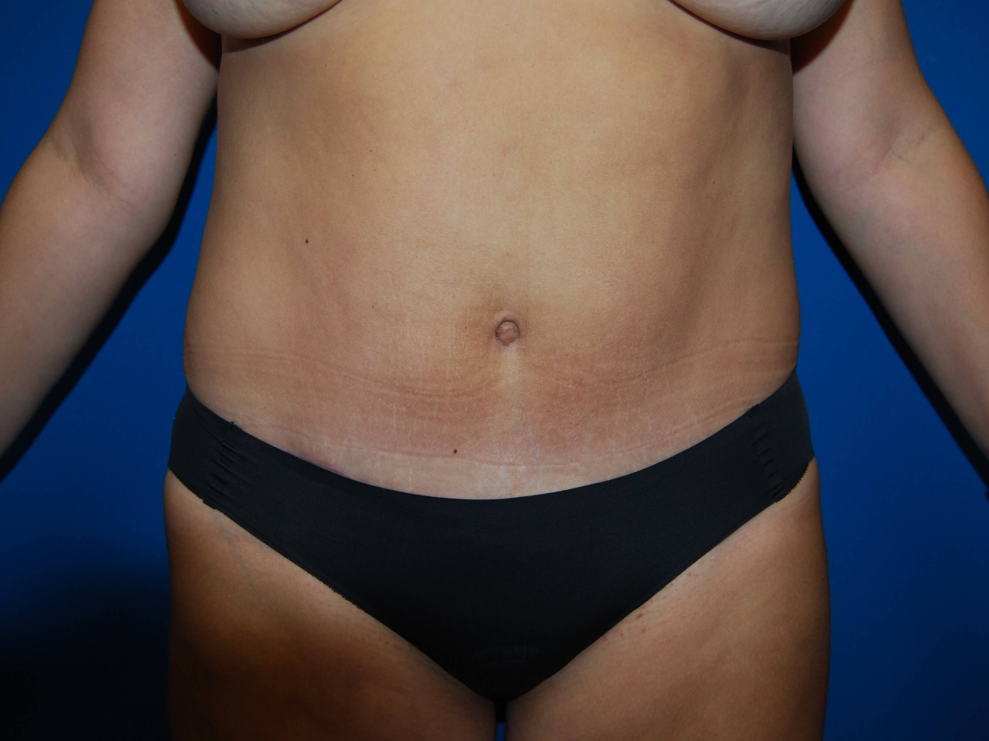 Front After Tummy Tuck