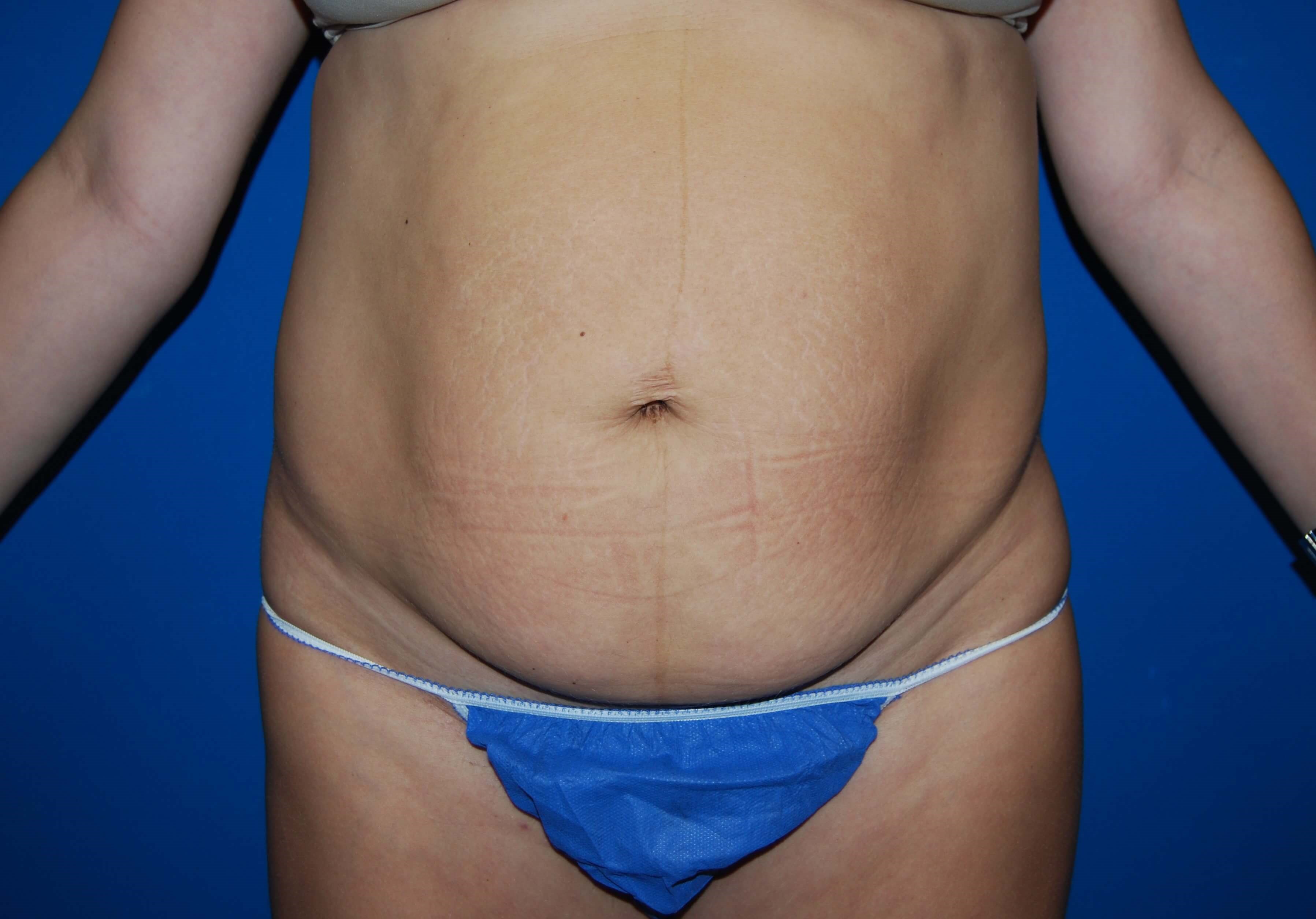 Front Before Tummy Tuck