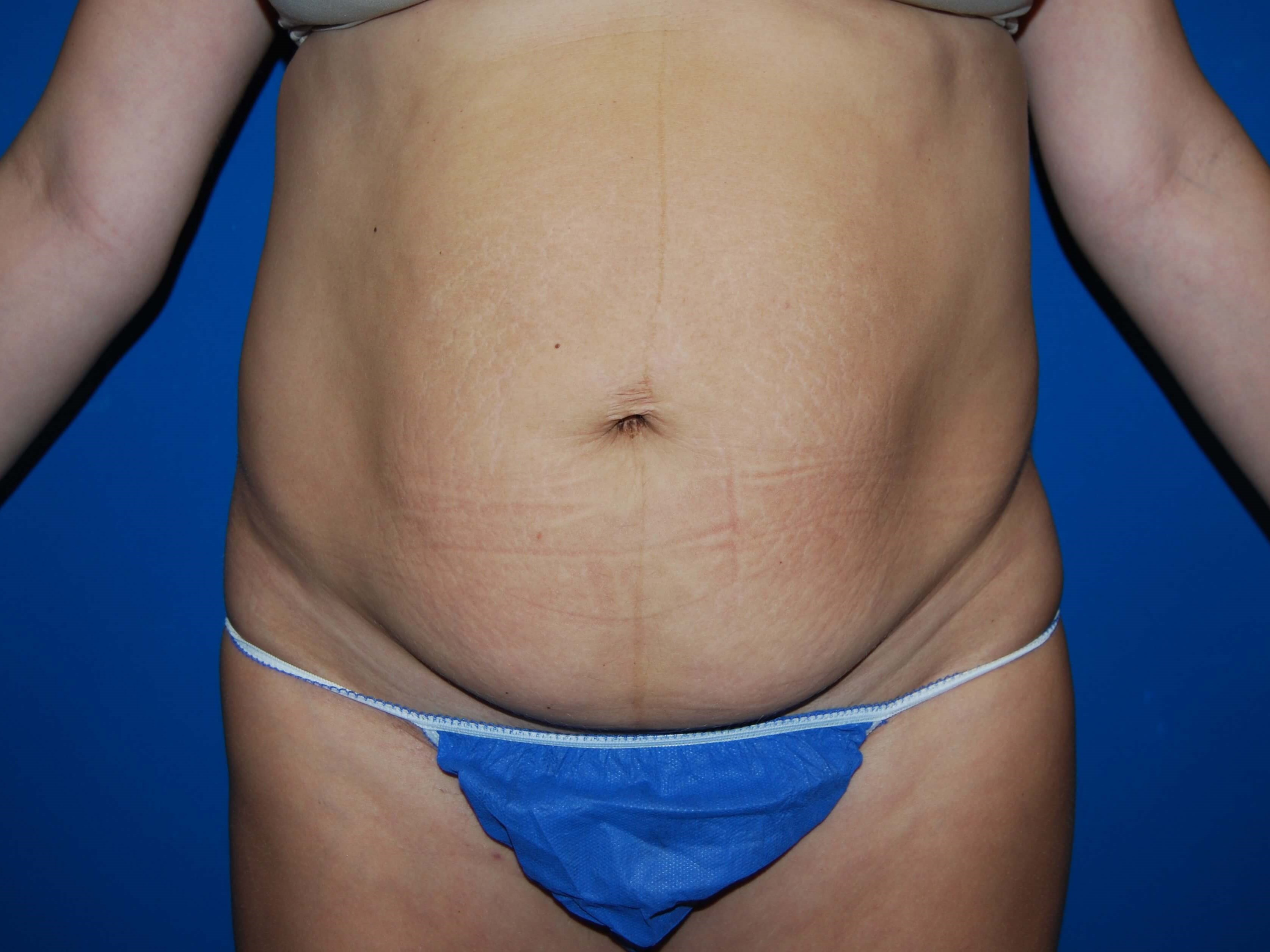 Front Before Tummy Tuck
