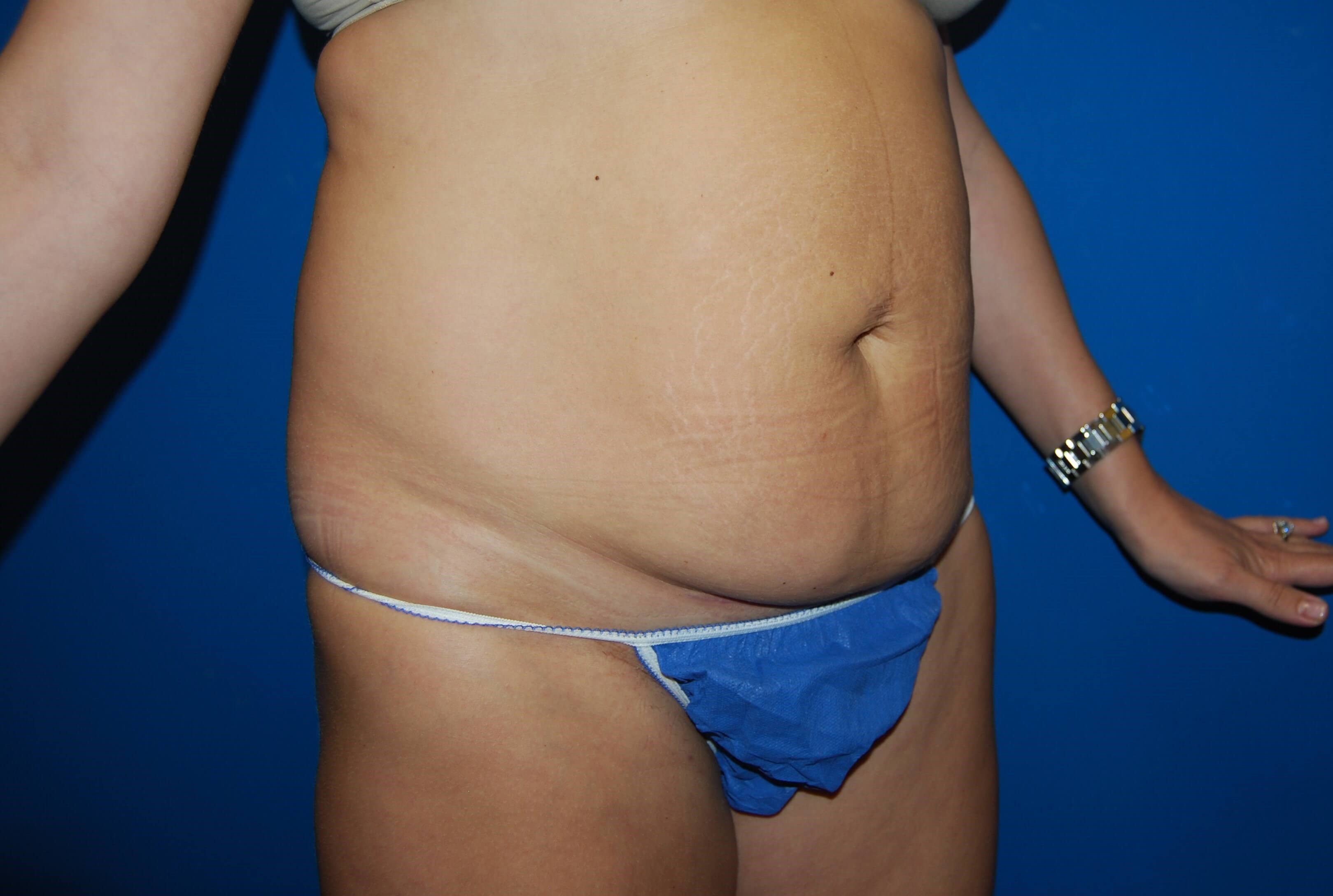 Right Before Tummy Tuck