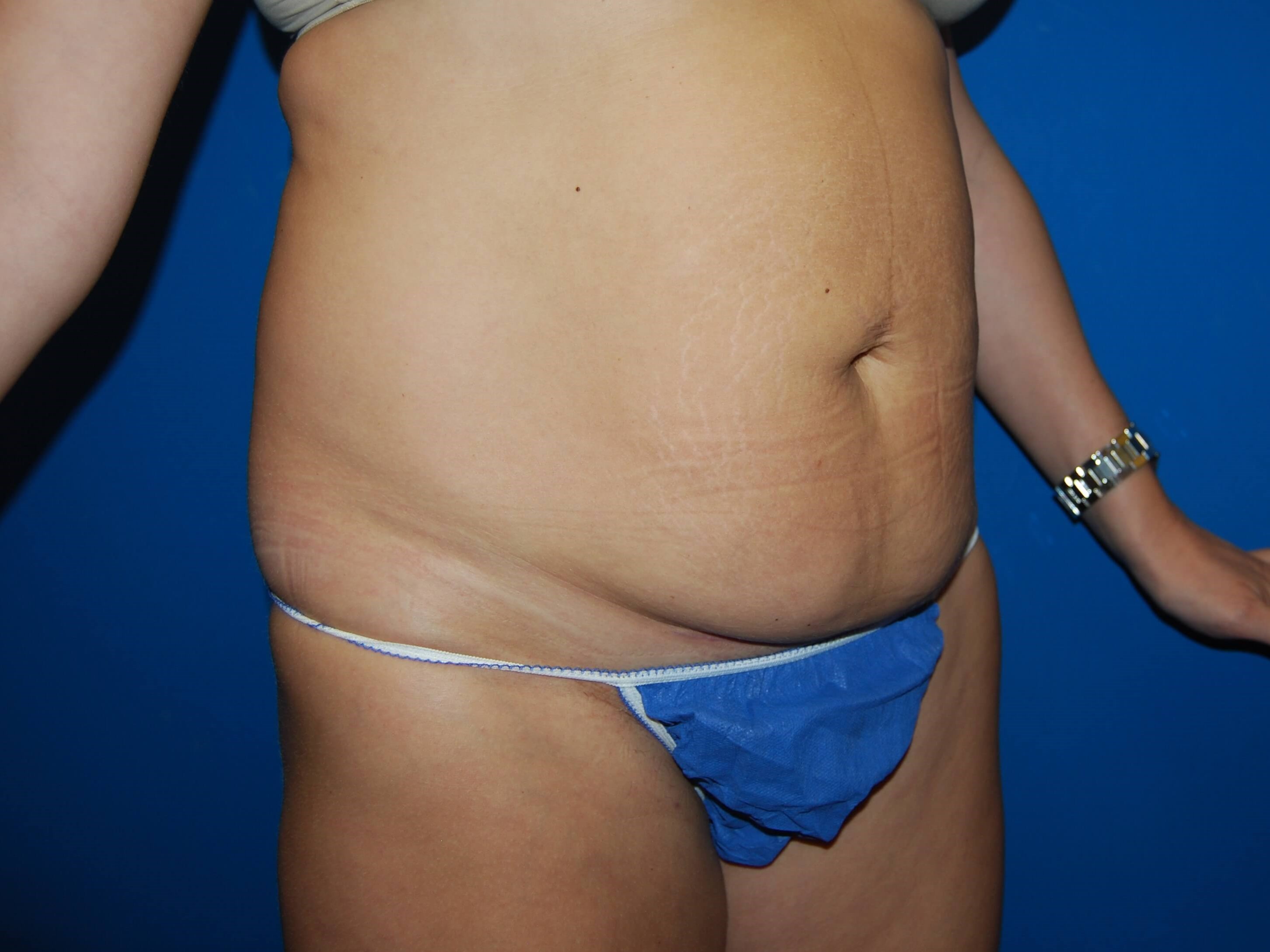 Right Before Tummy Tuck
