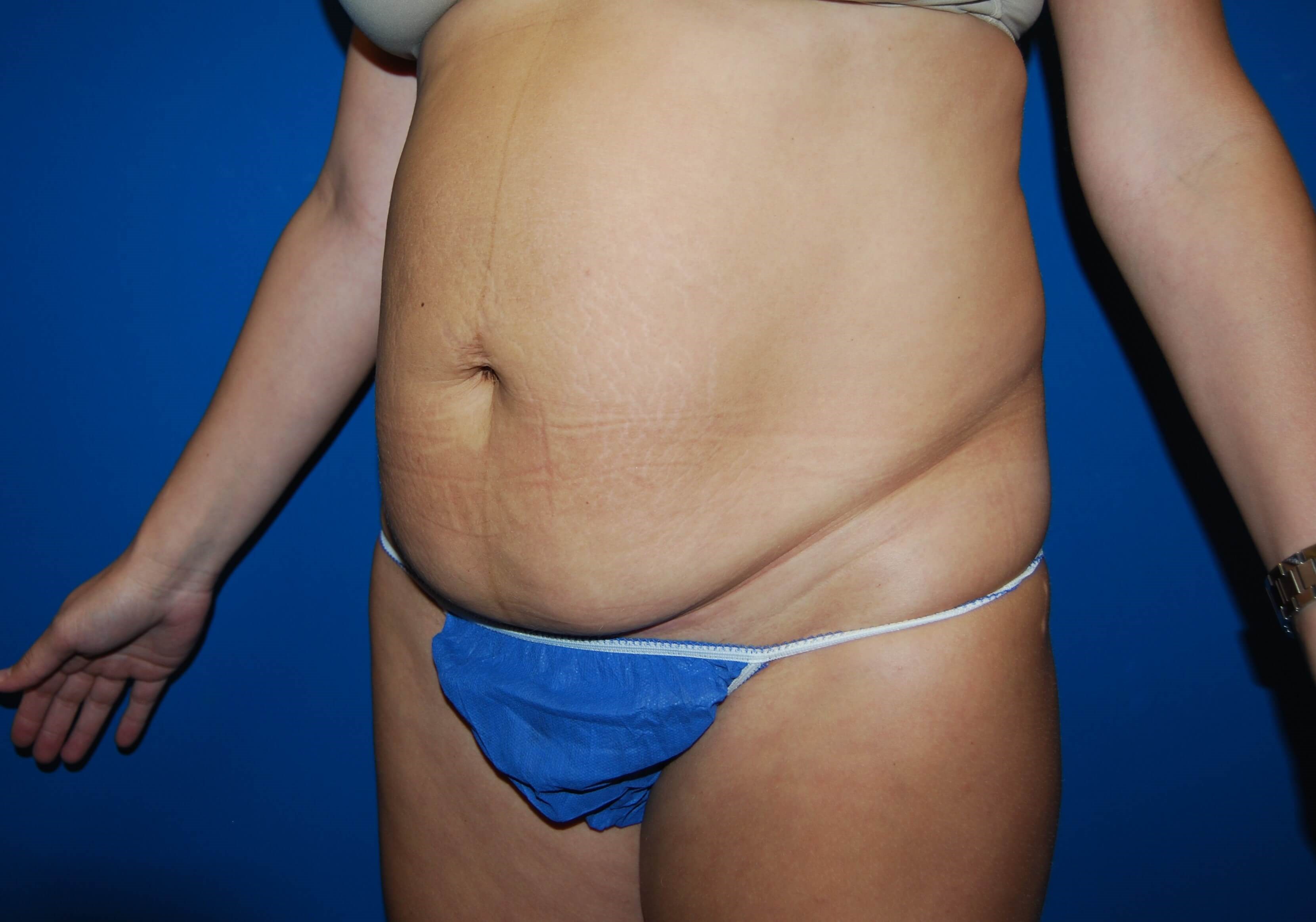 Left Before Tummy Tuck