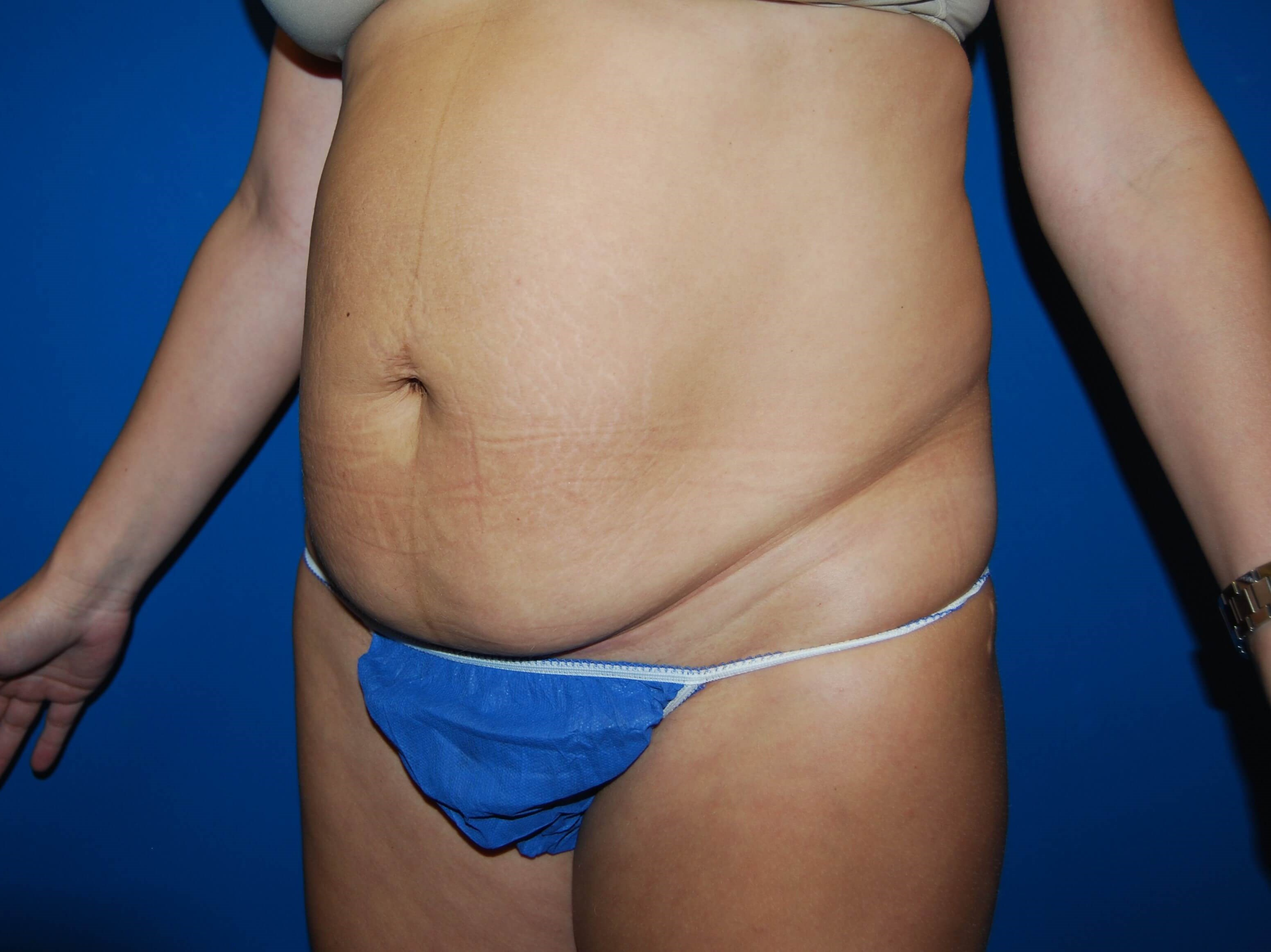 Left Before Tummy Tuck