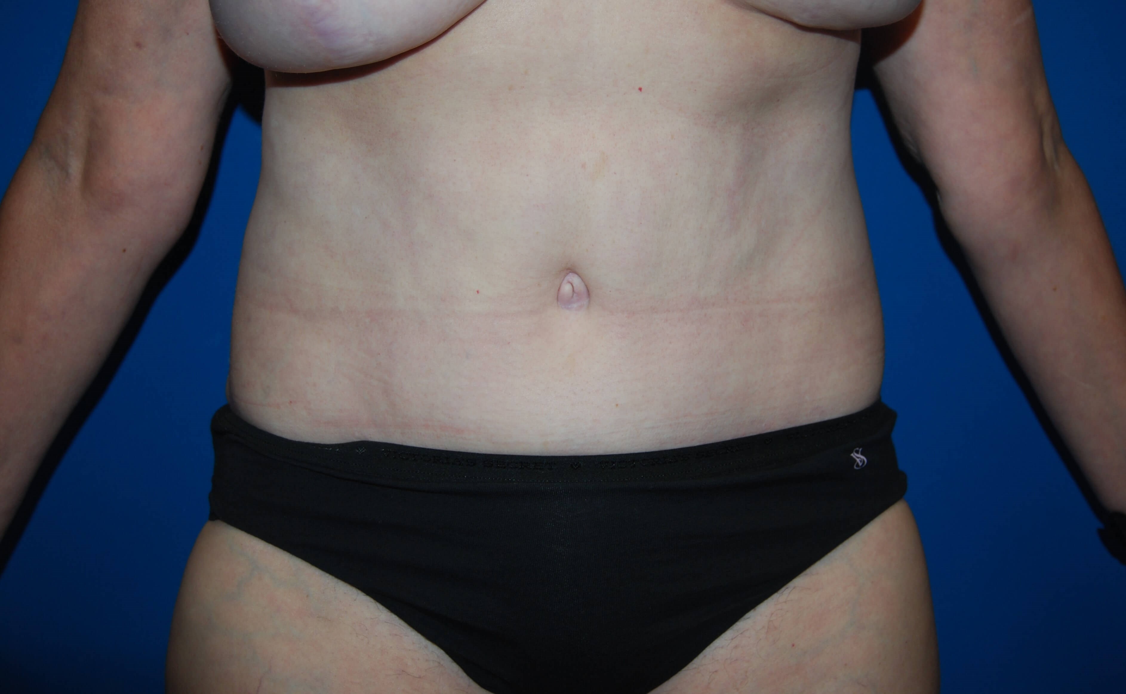 Tummy Tuck- Front After