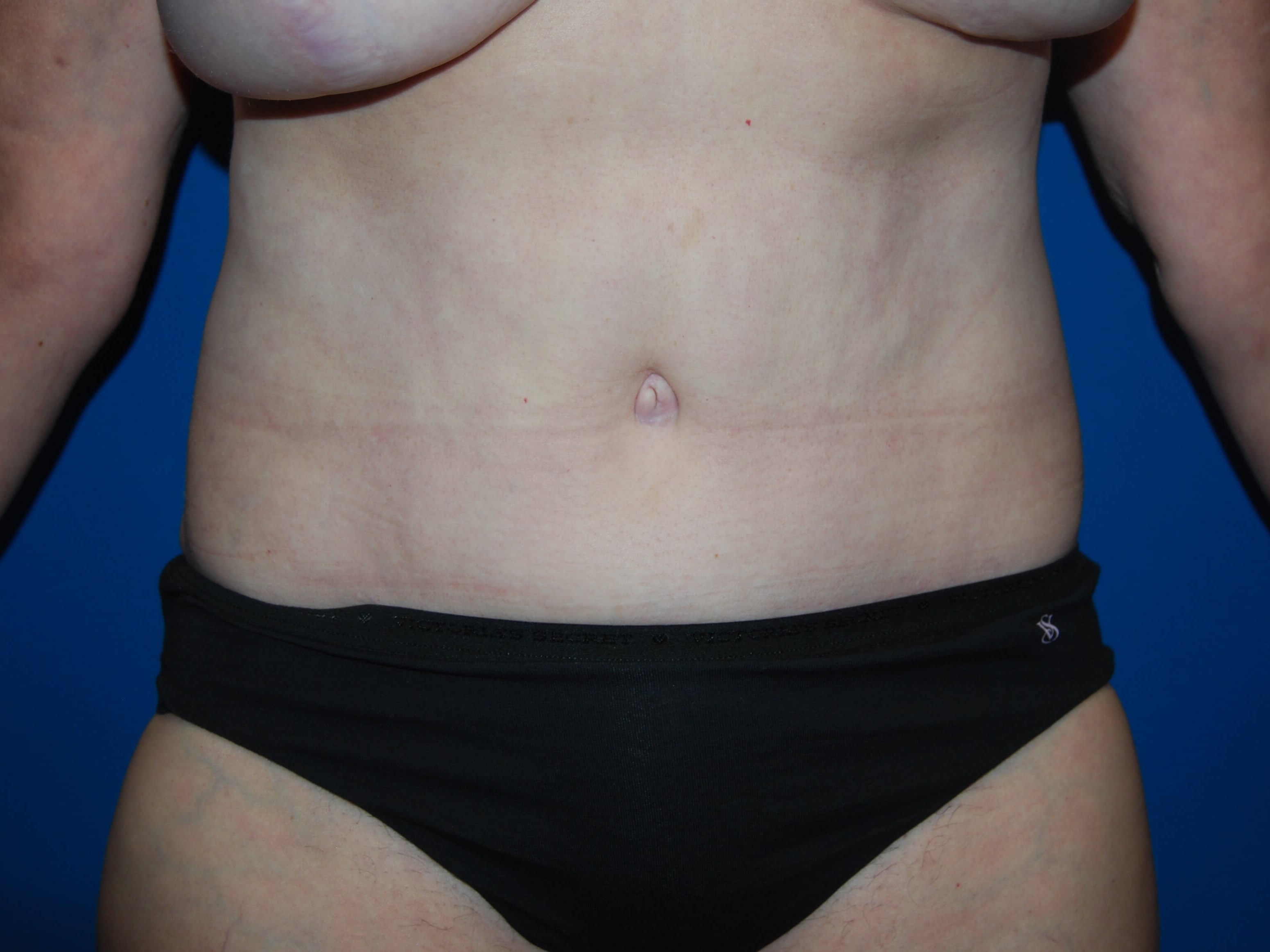 Tummy Tuck- Front After