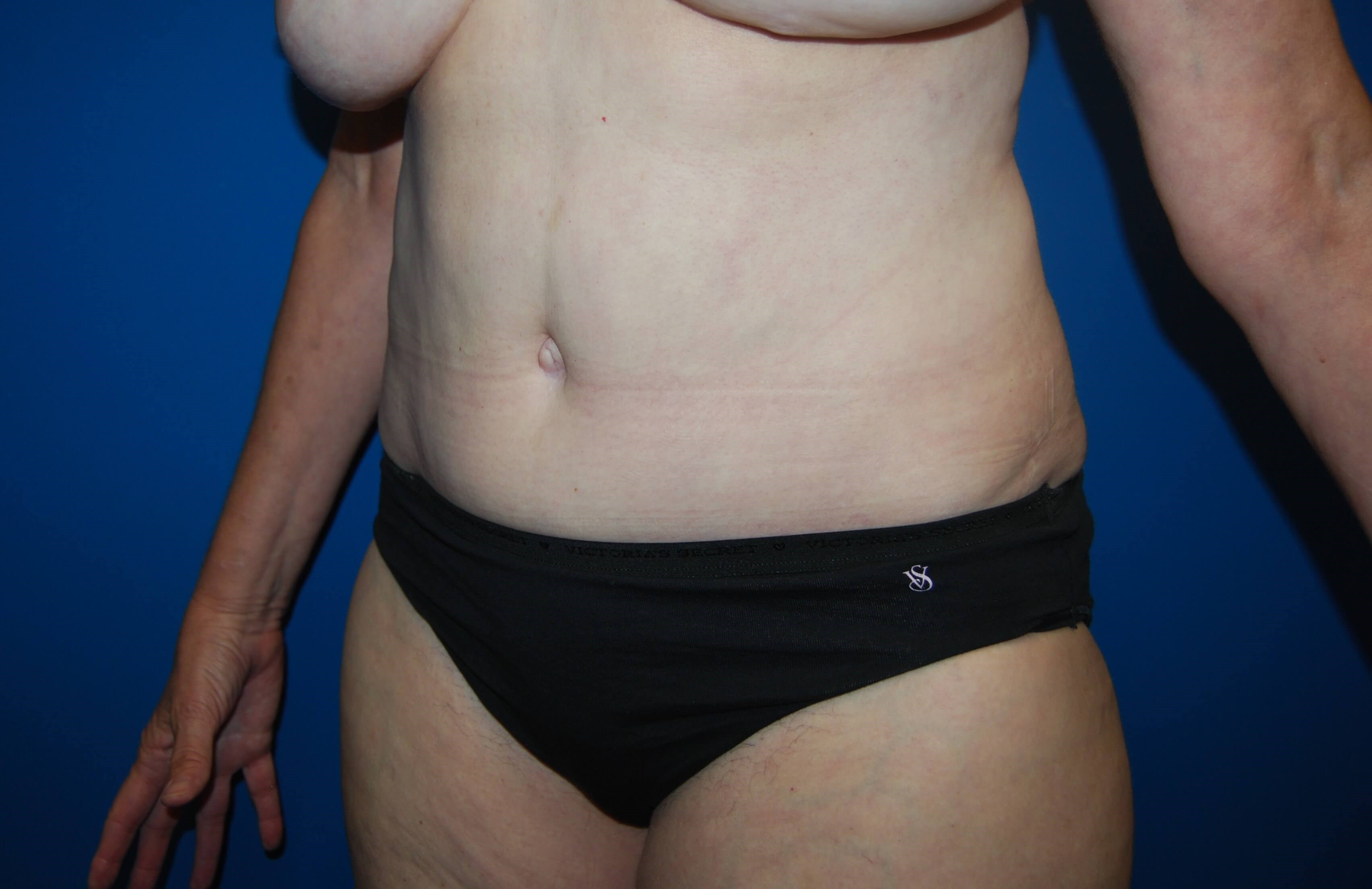 Tummy Tuck - Side After