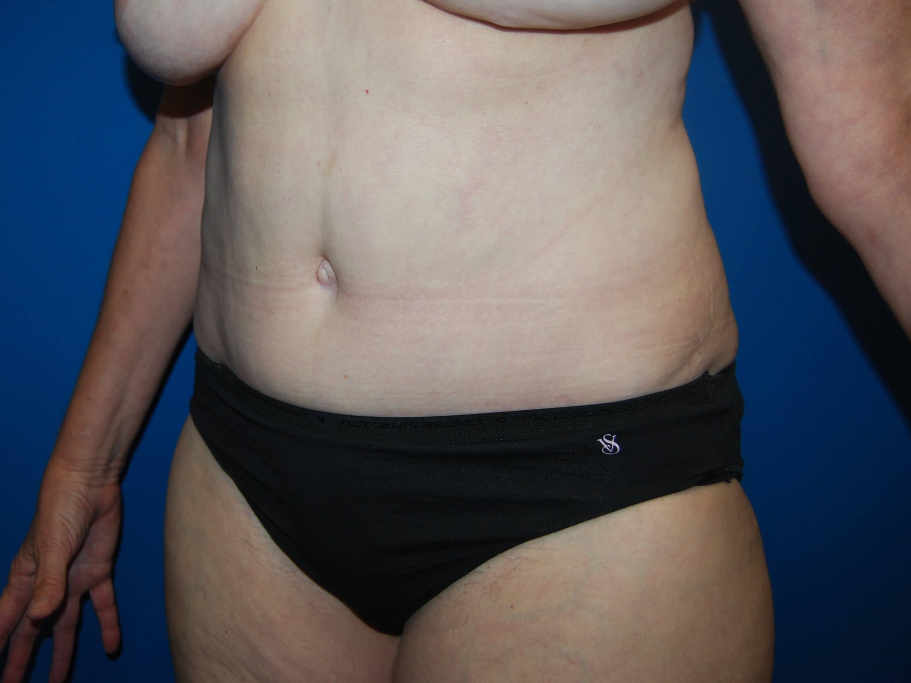 Tummy Tuck - Side After