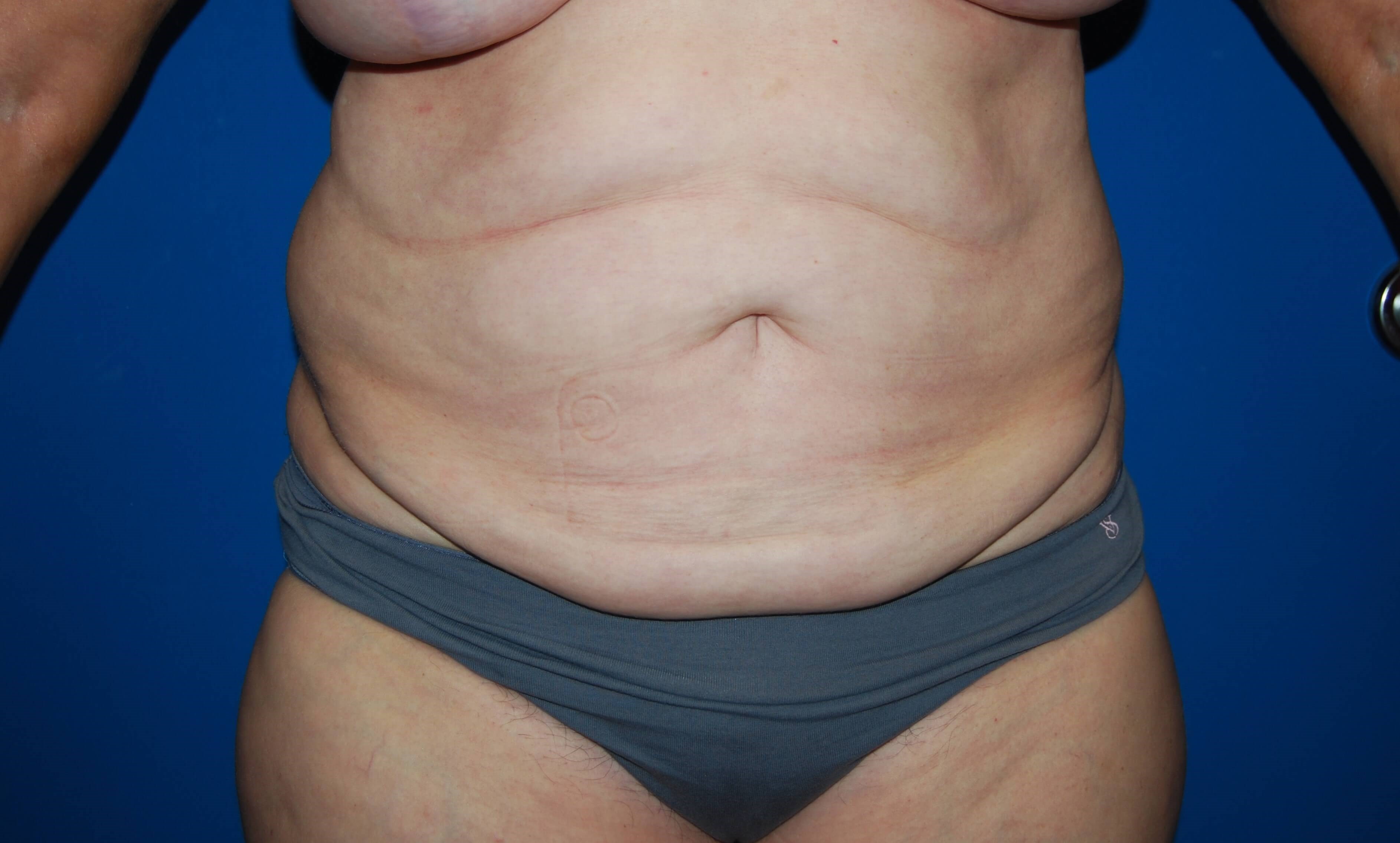 Tummy Tuck- Front Before