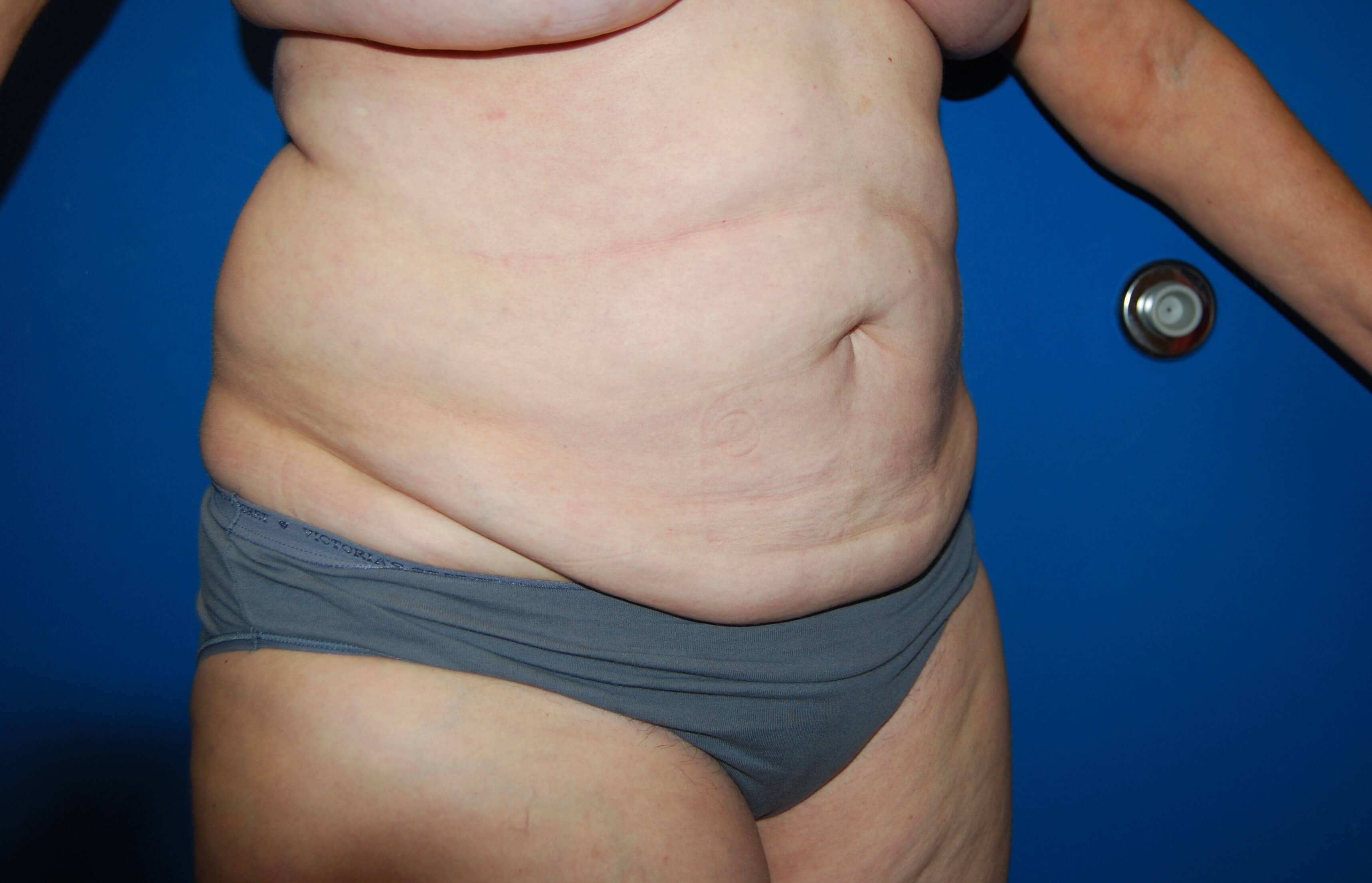 Tummy Tuck- Side Before