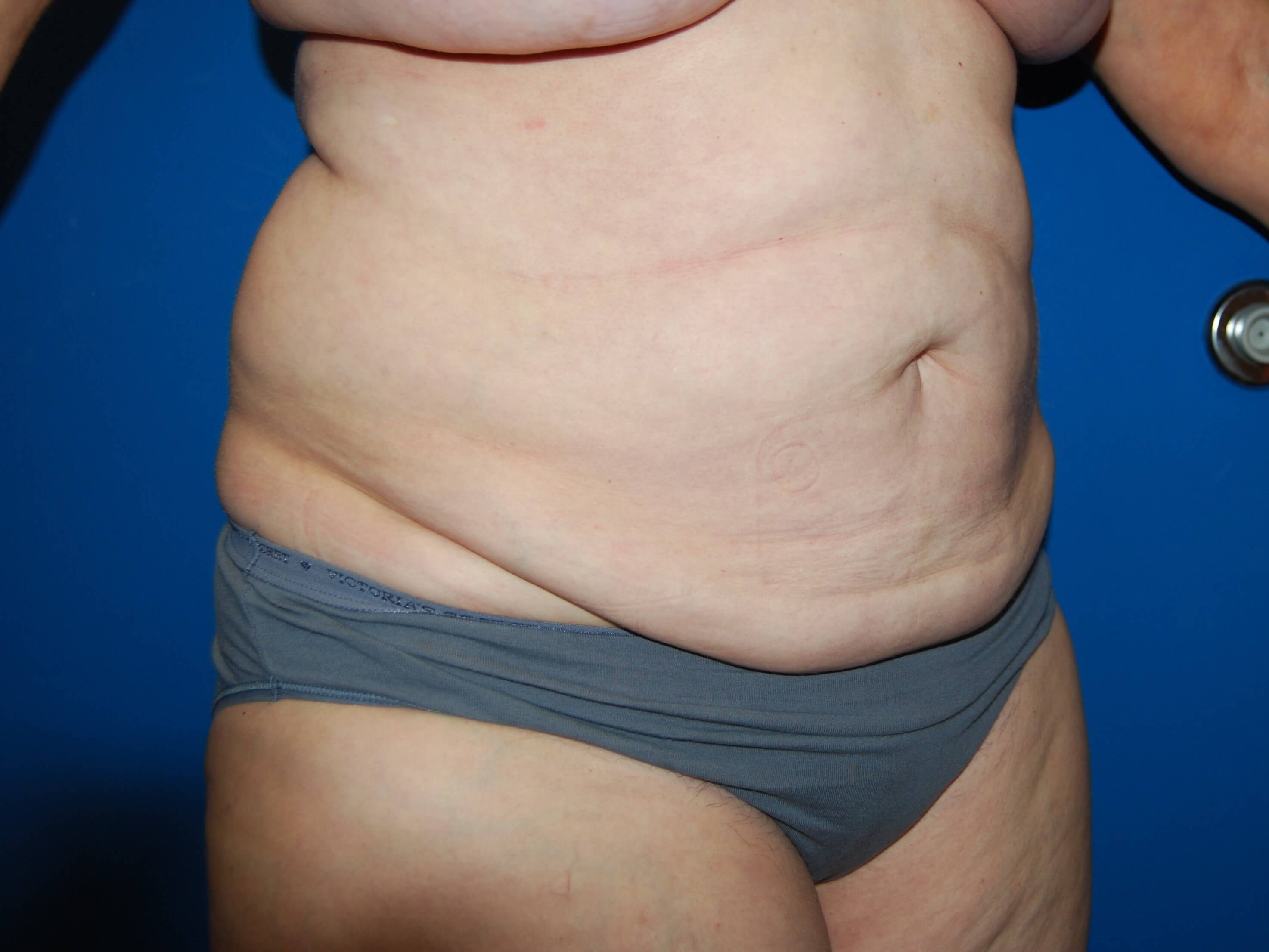 Tummy Tuck- Side Before
