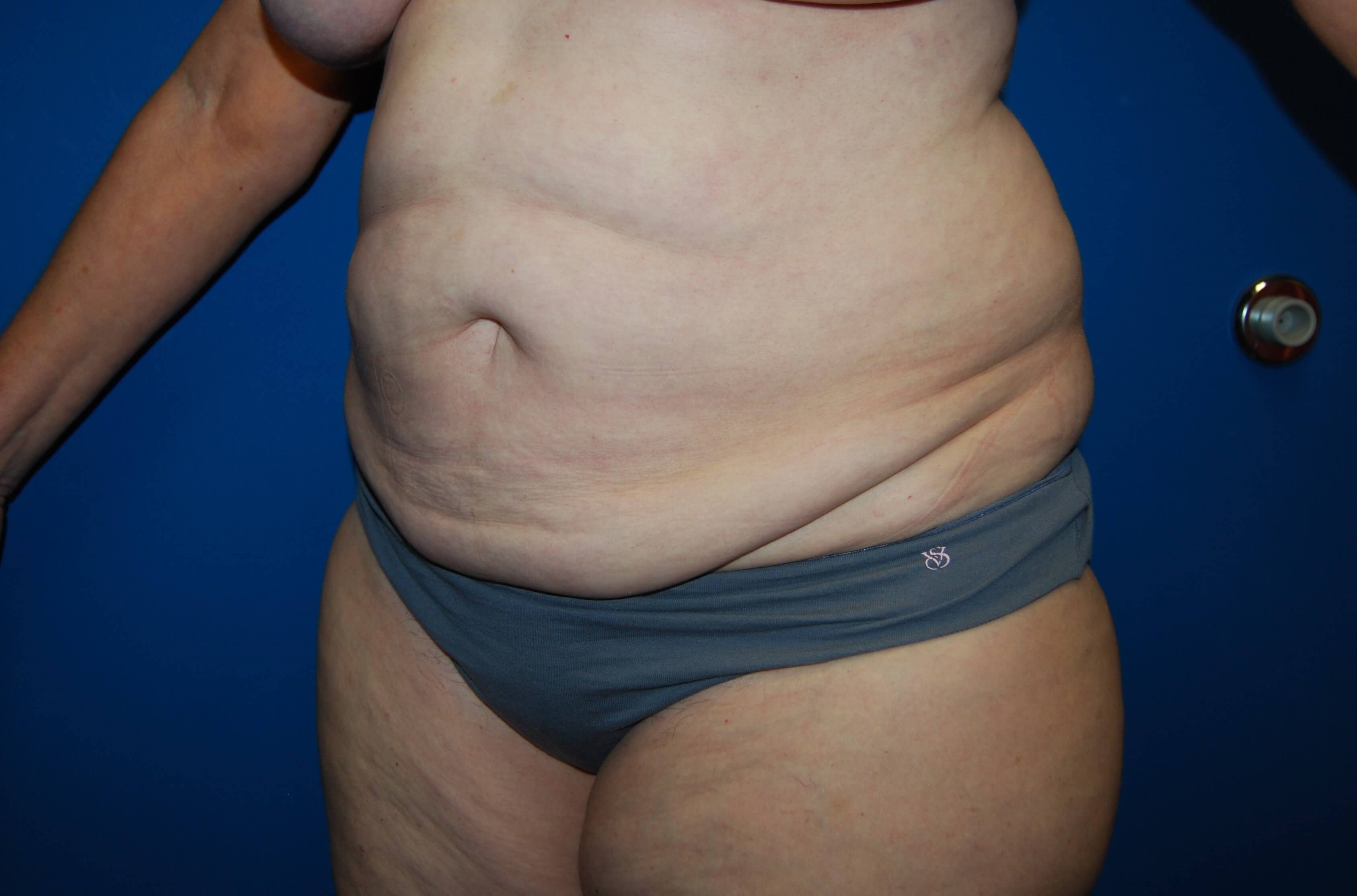 Tummy Tuck - Side Before