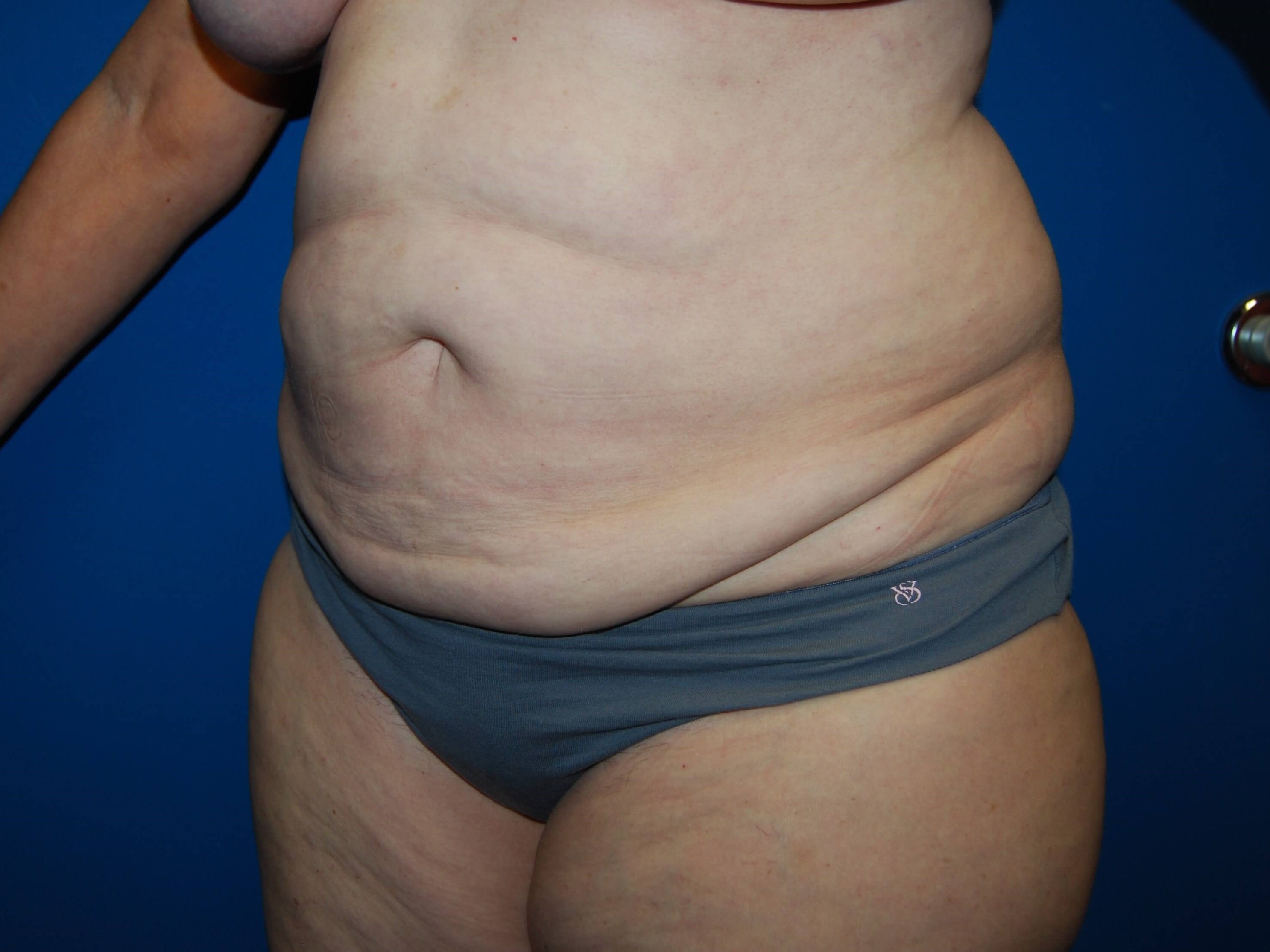 Tummy Tuck - Side Before