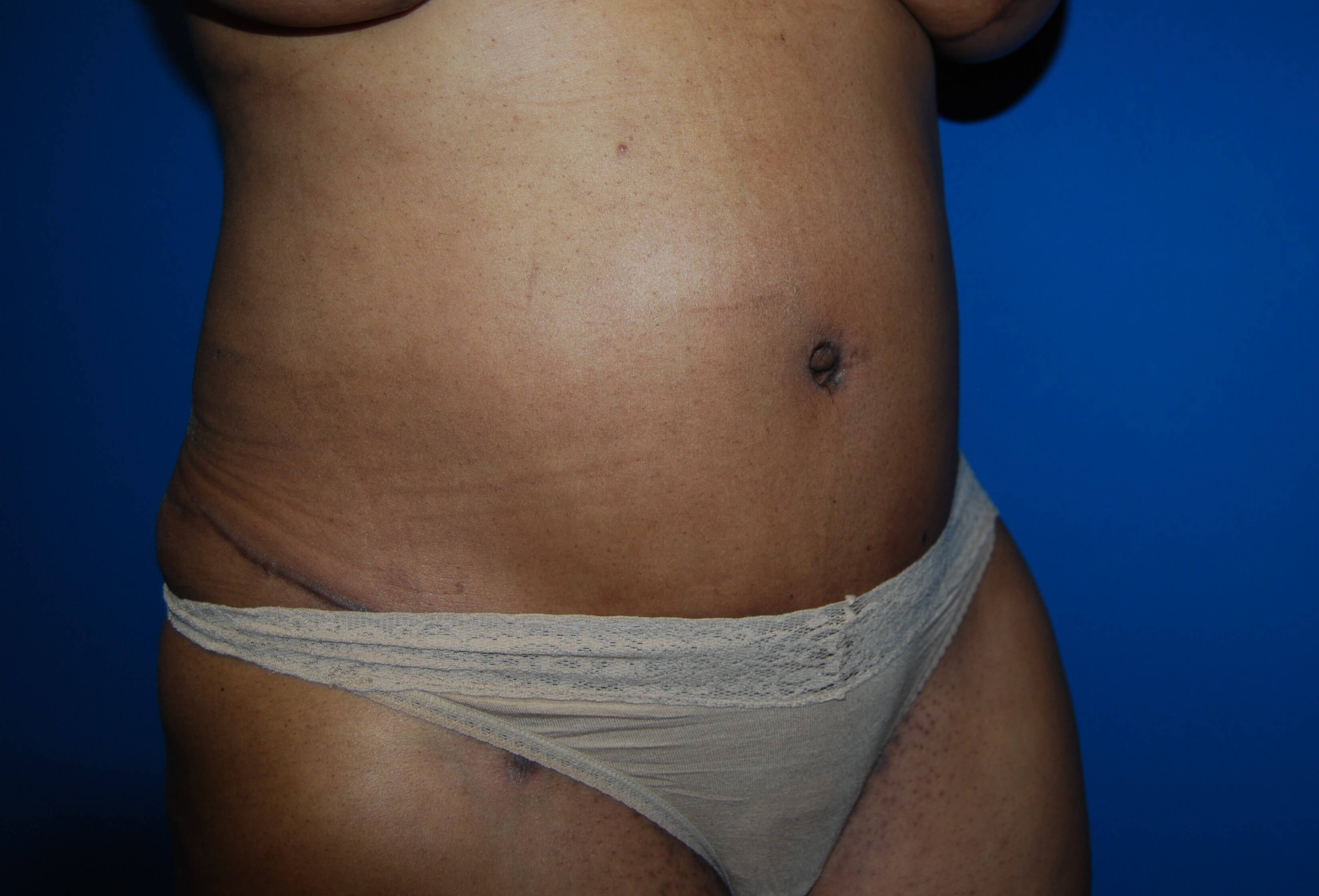 Tummy Tuck- Side After
