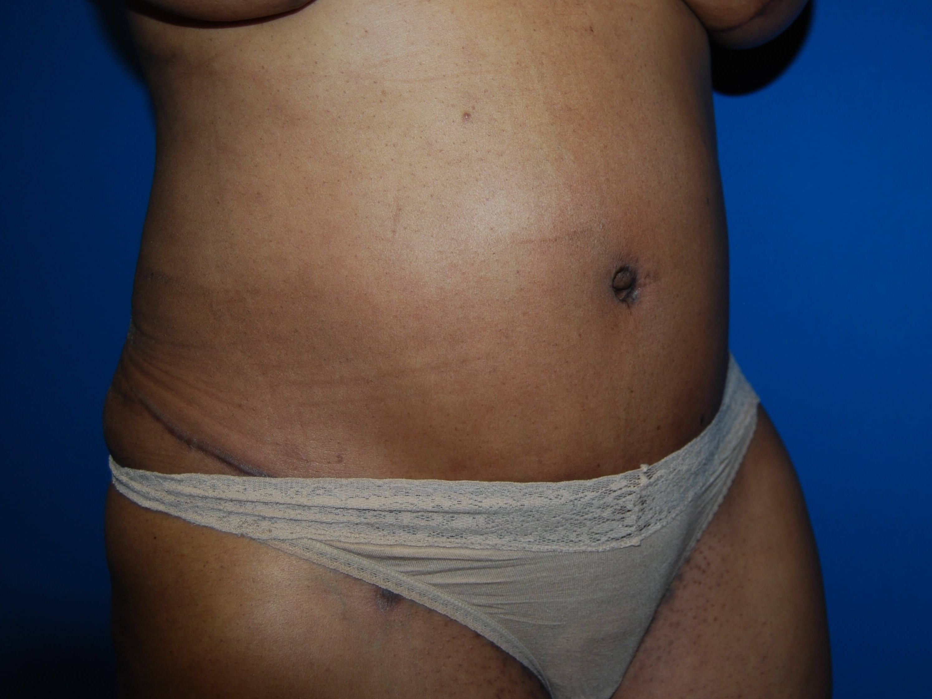 Tummy Tuck- Side After