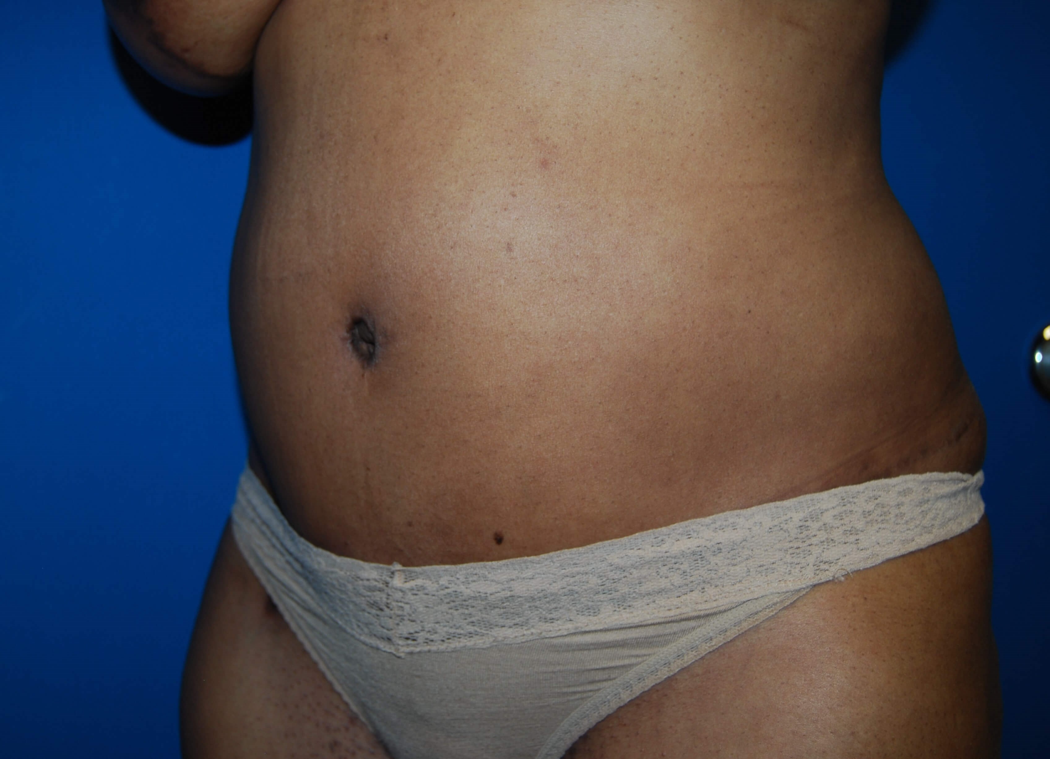 Tummy Tuck - Side After