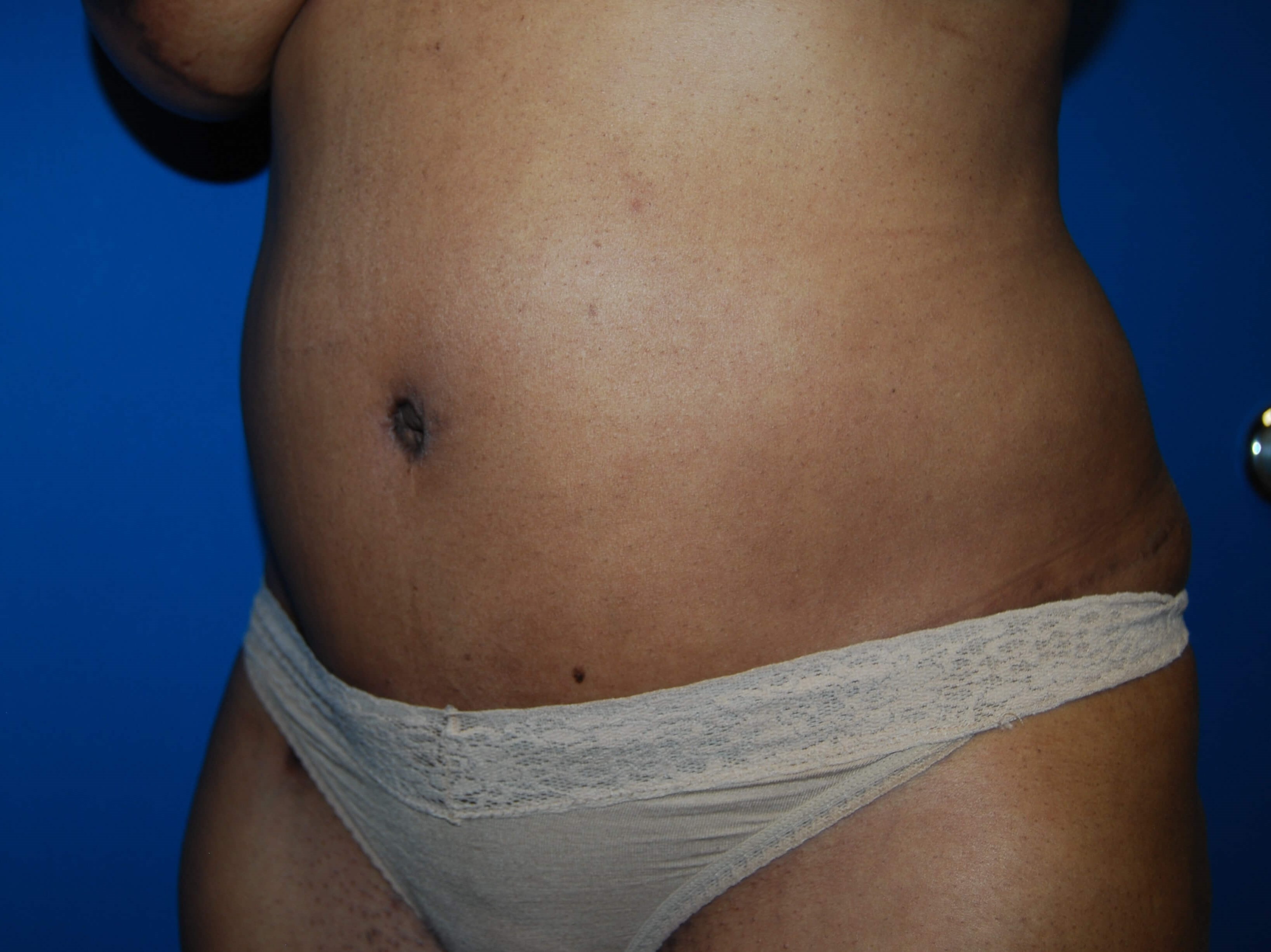Tummy Tuck - Side After