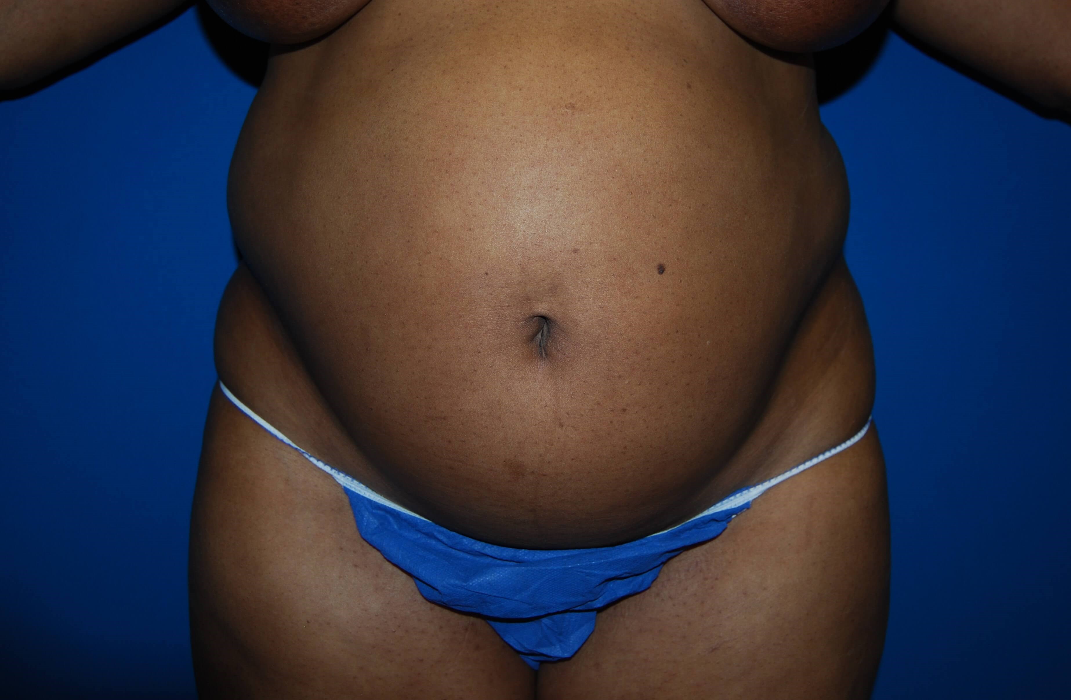 Tummy Tuck - Front Before